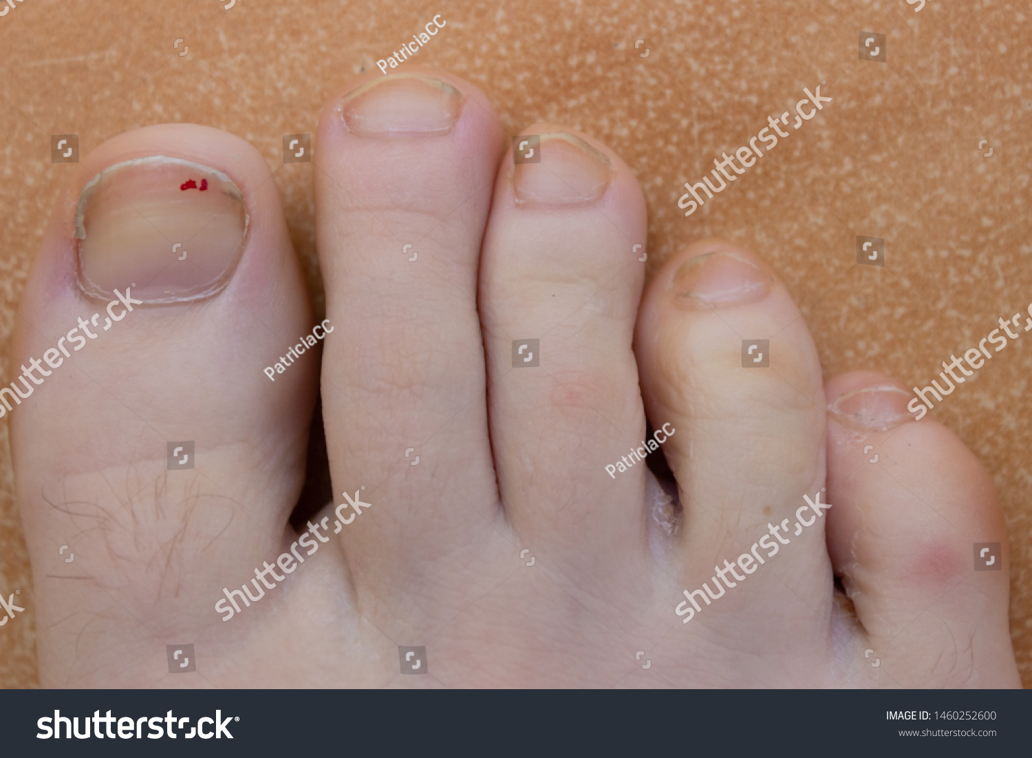 Foot Close Callus Toe Details Feet 