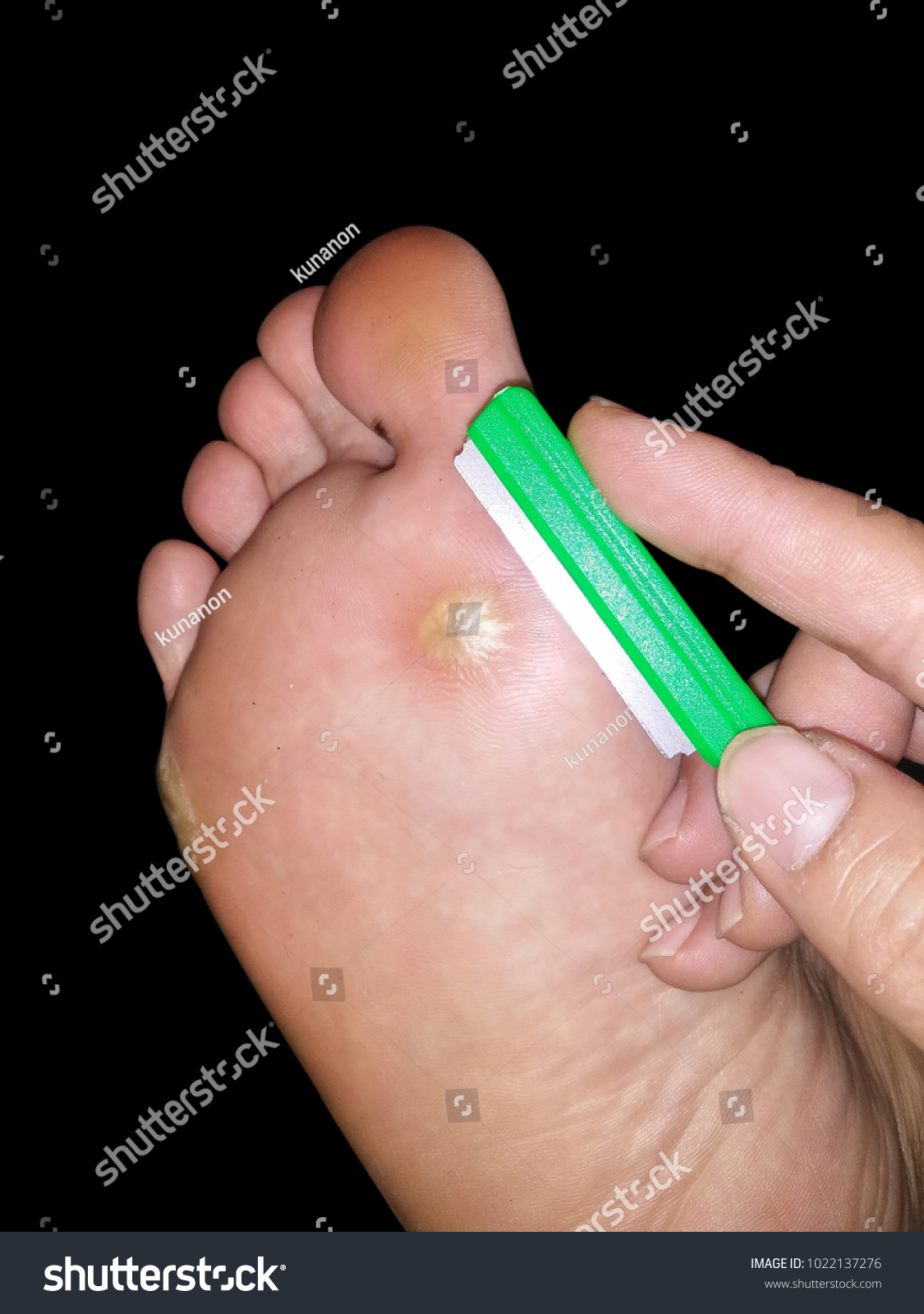 corns on black feet