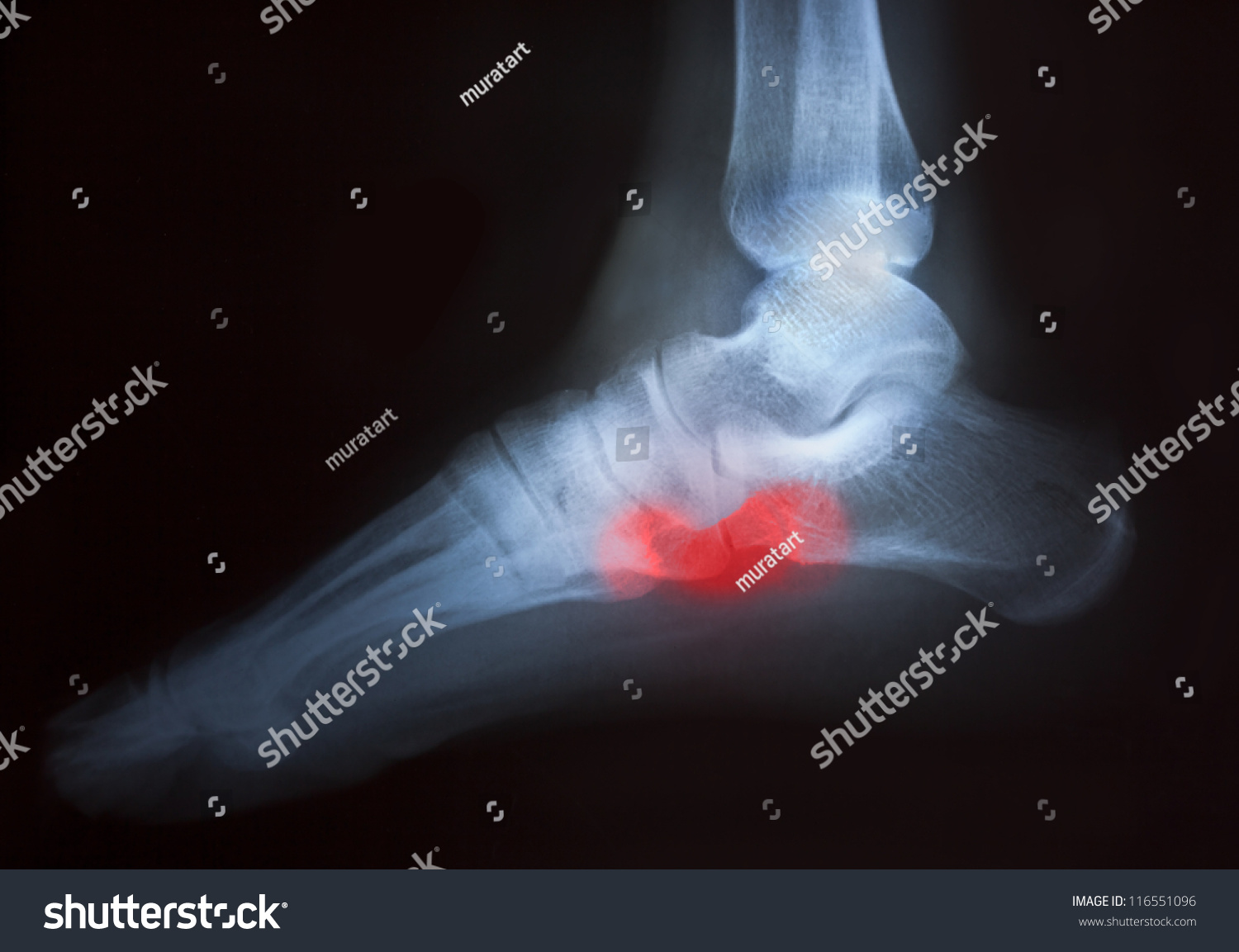 Foot Pain On Xray Stock Photo 116551096 - Shutterstock
