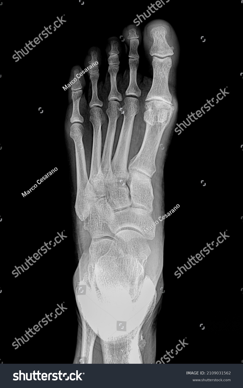 Radiography Foot Images Stock Photos Vectors Shutterstock