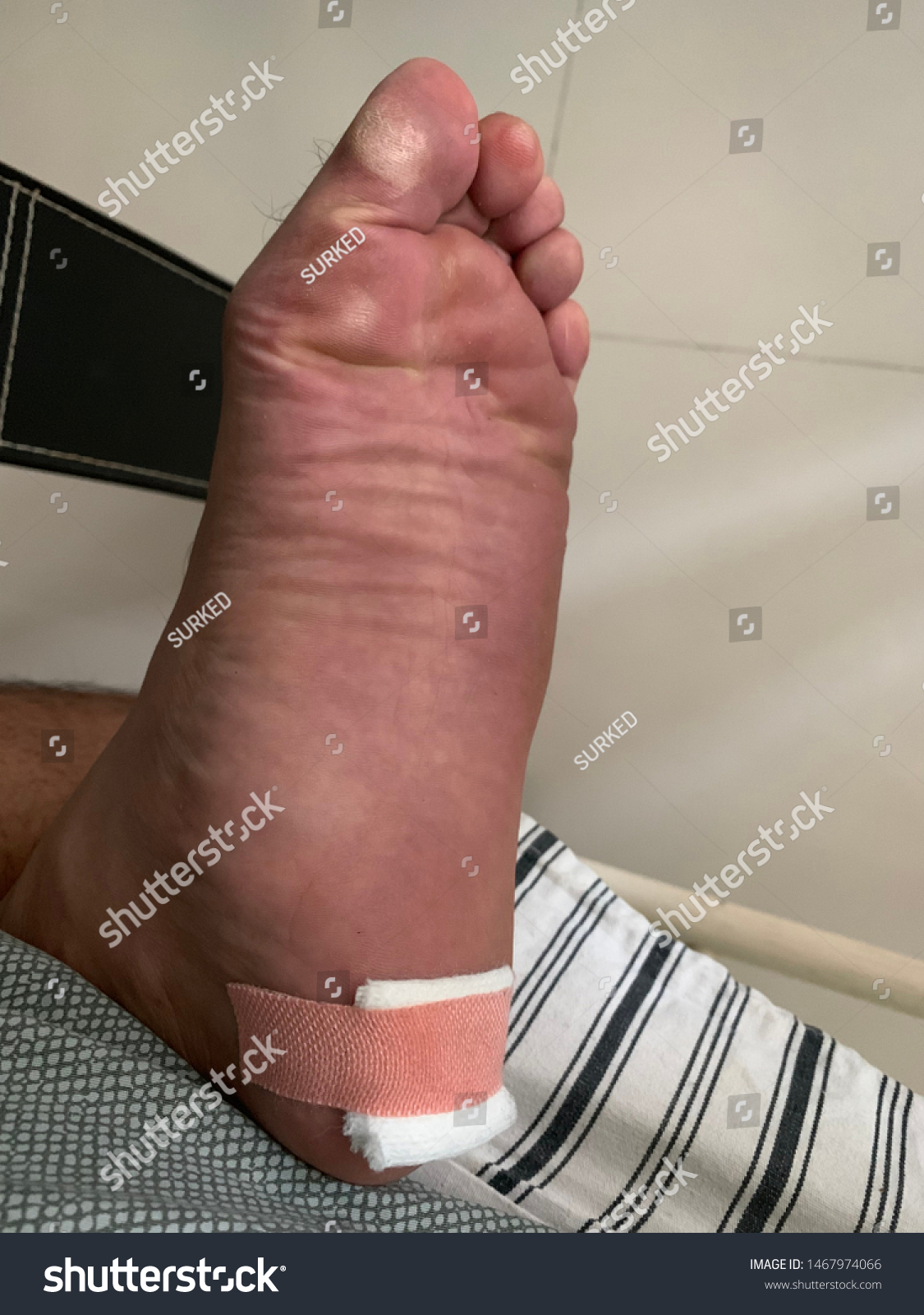 Foot Ulcer Wounds Broken Glass Stock Photo 1467974066 | Shutterstock