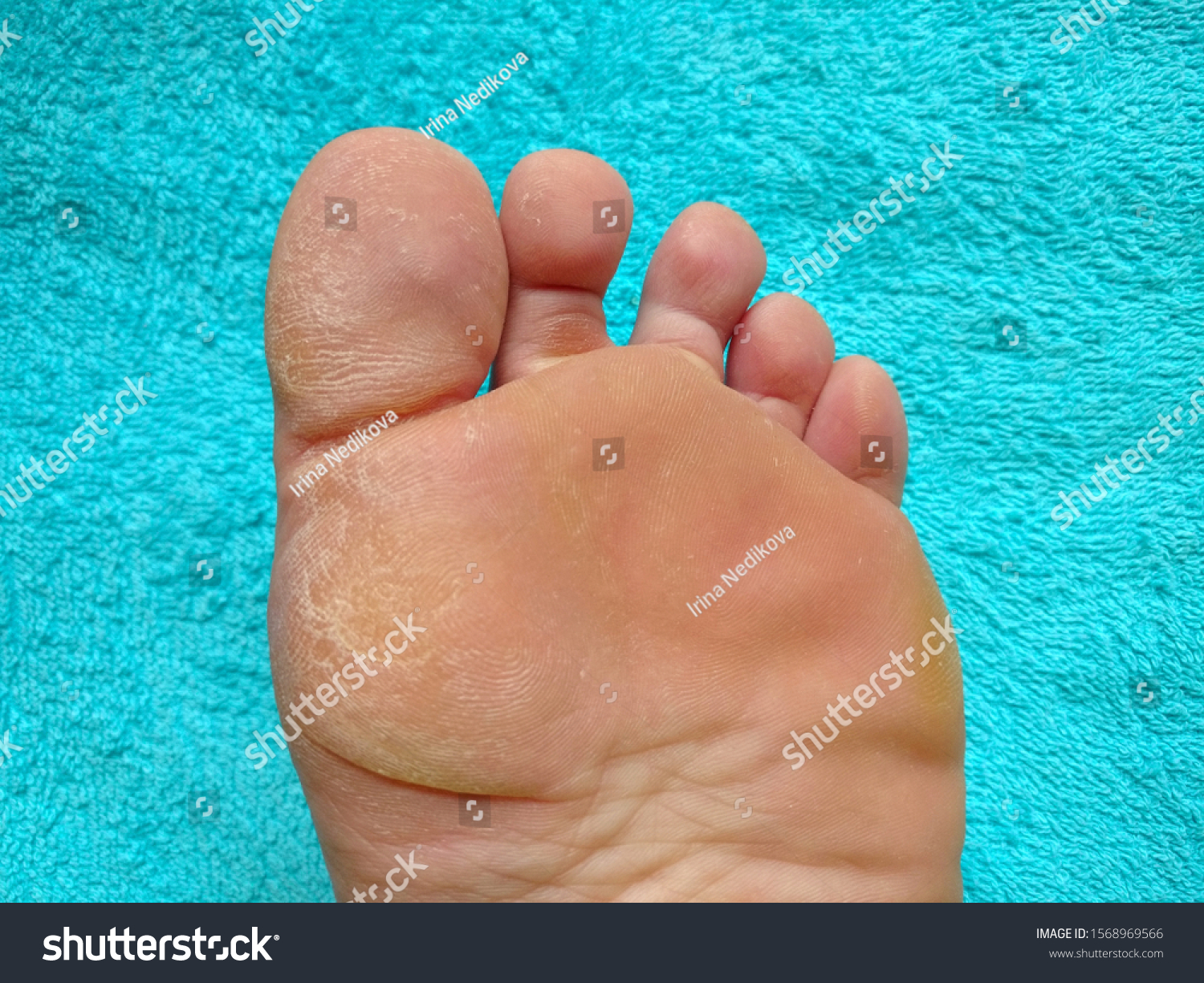 dry and calloused feet