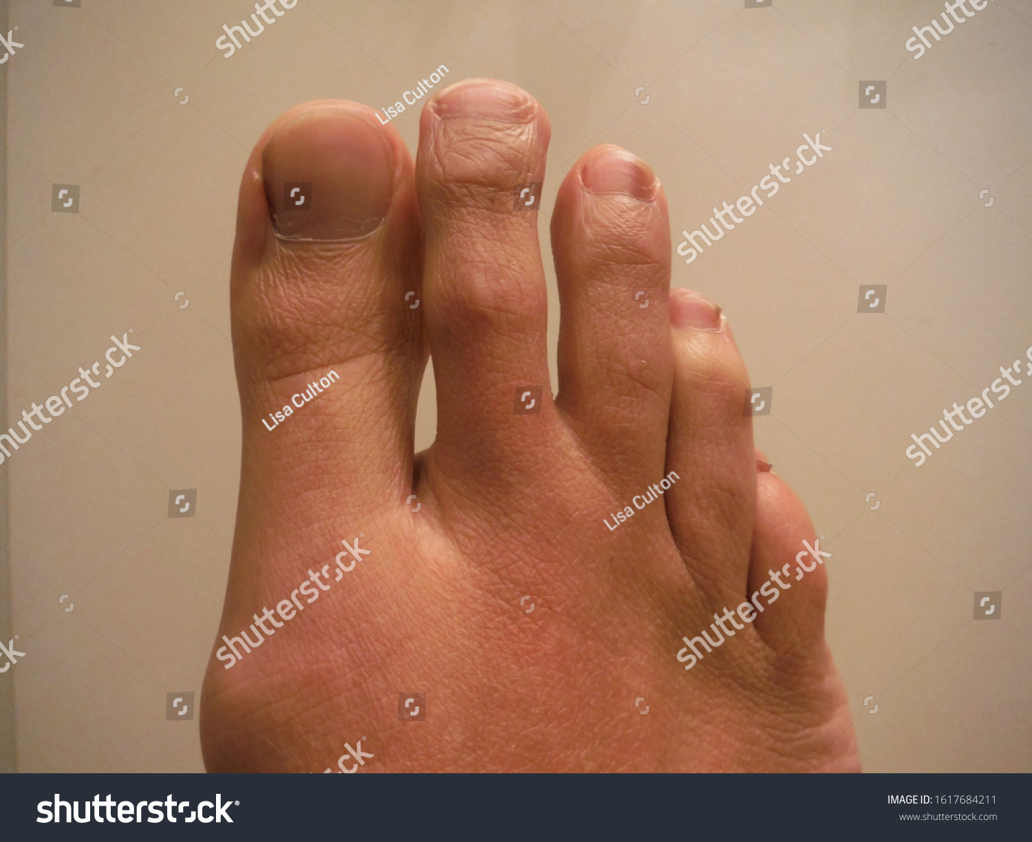 42 morton s toe images stock photos vectors shutterstock