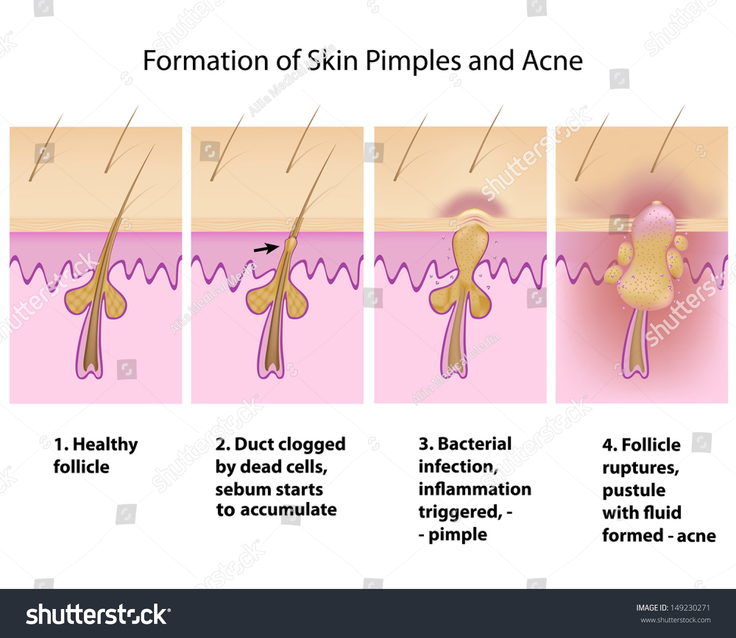 Formation Of Skin Acnes And Pimples Stock Photo 149230271 : Shutterstock