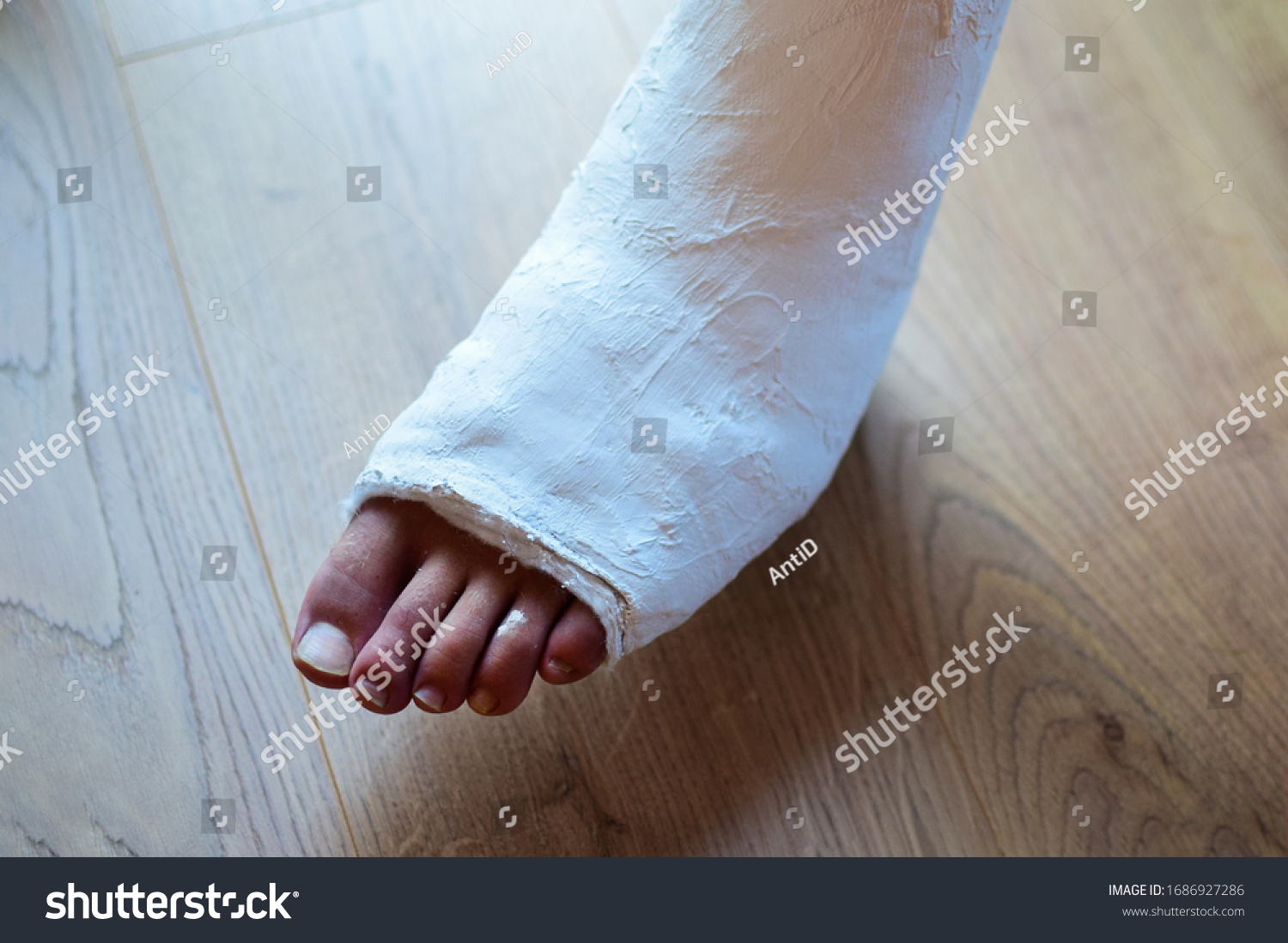 Fracture Lower Leg Cast Stock Photo 1686927286 | Shutterstock