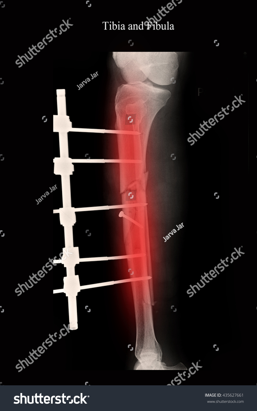 icd 10 fracture right tibia fibula