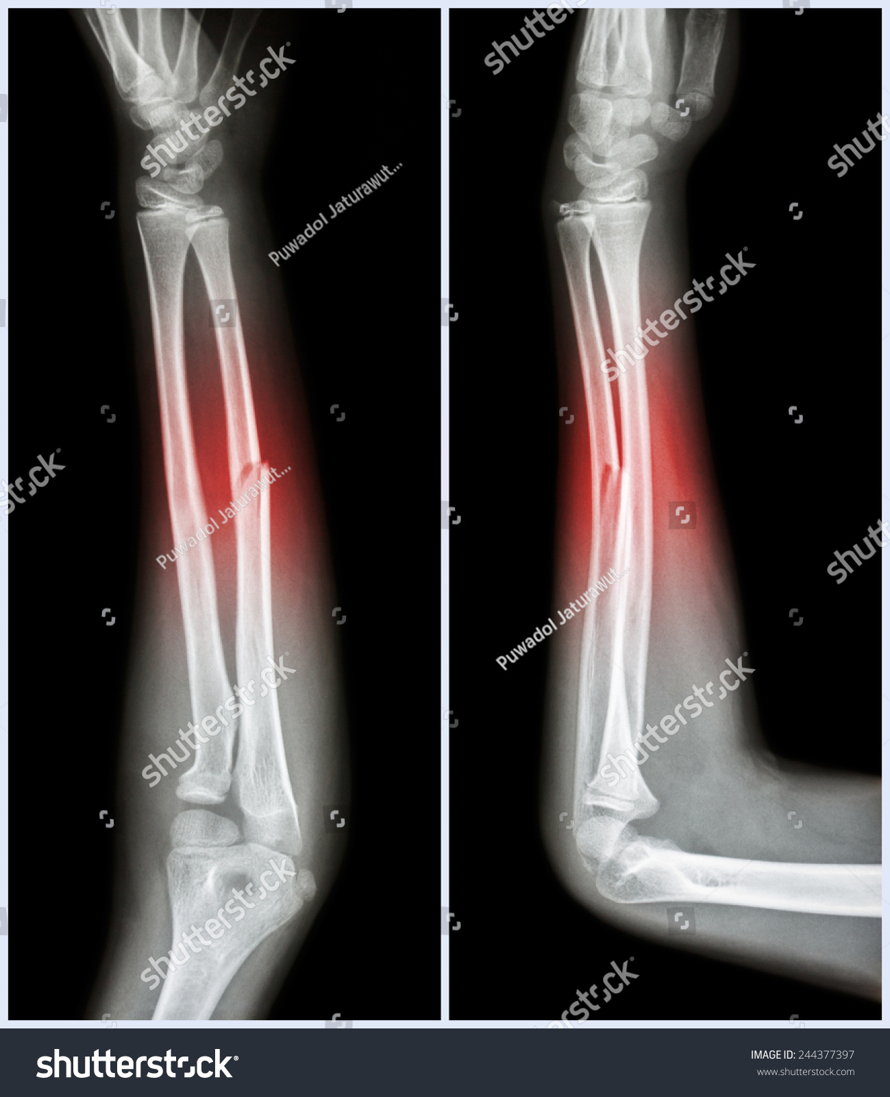 Fracture Shaft Ulnar Bone Forearm Bone Stock Photo 244377397 | Shutterstock