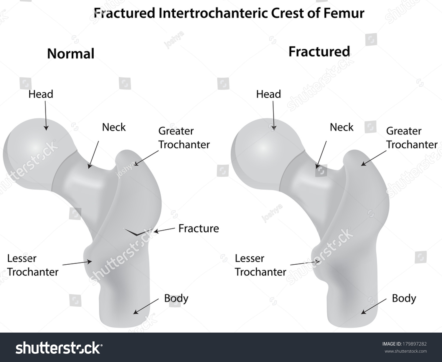 fractured-intertrochanteric-crest-diagram-labeled-179897282