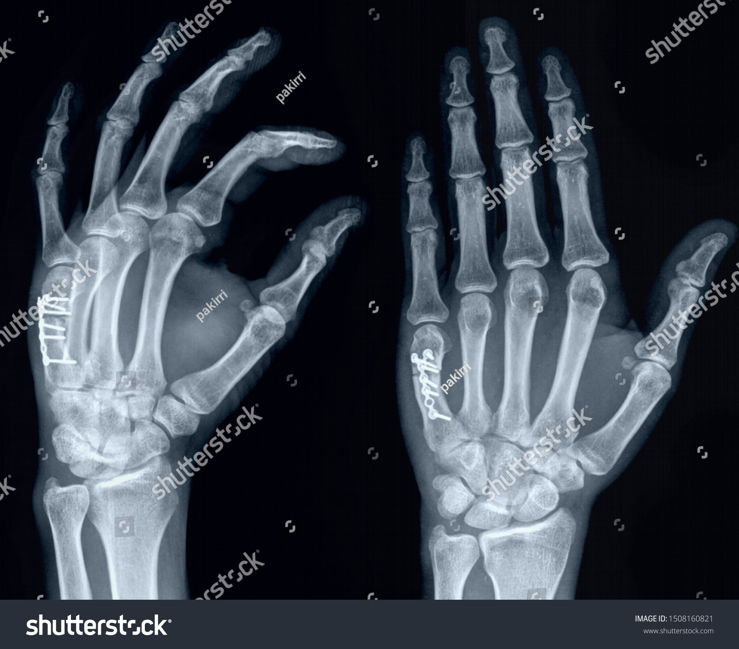 Fractured X Ray Hand Bones Stock Photo (Edit Now) 1508160821