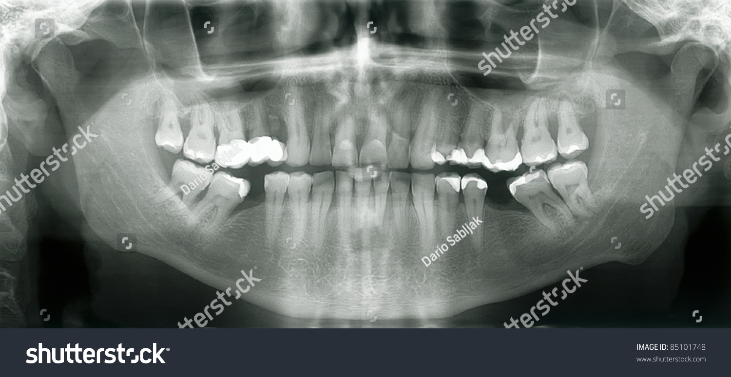 Front Xray Image Of Human Mouth With Dental Fillings Stock Photo ...