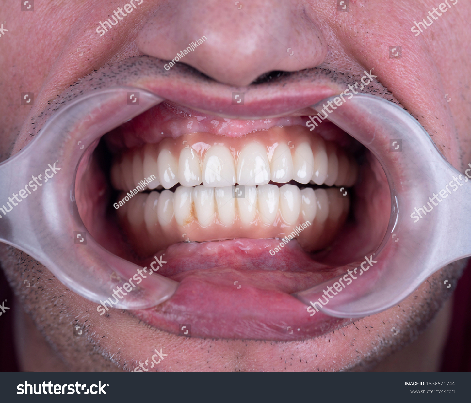 Full Mouth Dental Stock Photos Images Photography Shutterstock