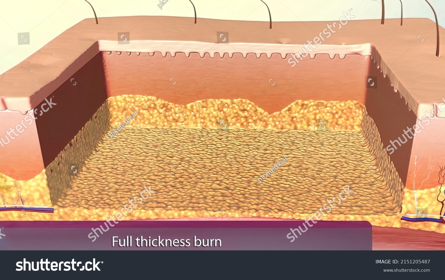 Full Thickness Burns Third Degree Burns Stock Illustration 2151205487 Shutterstock 4170