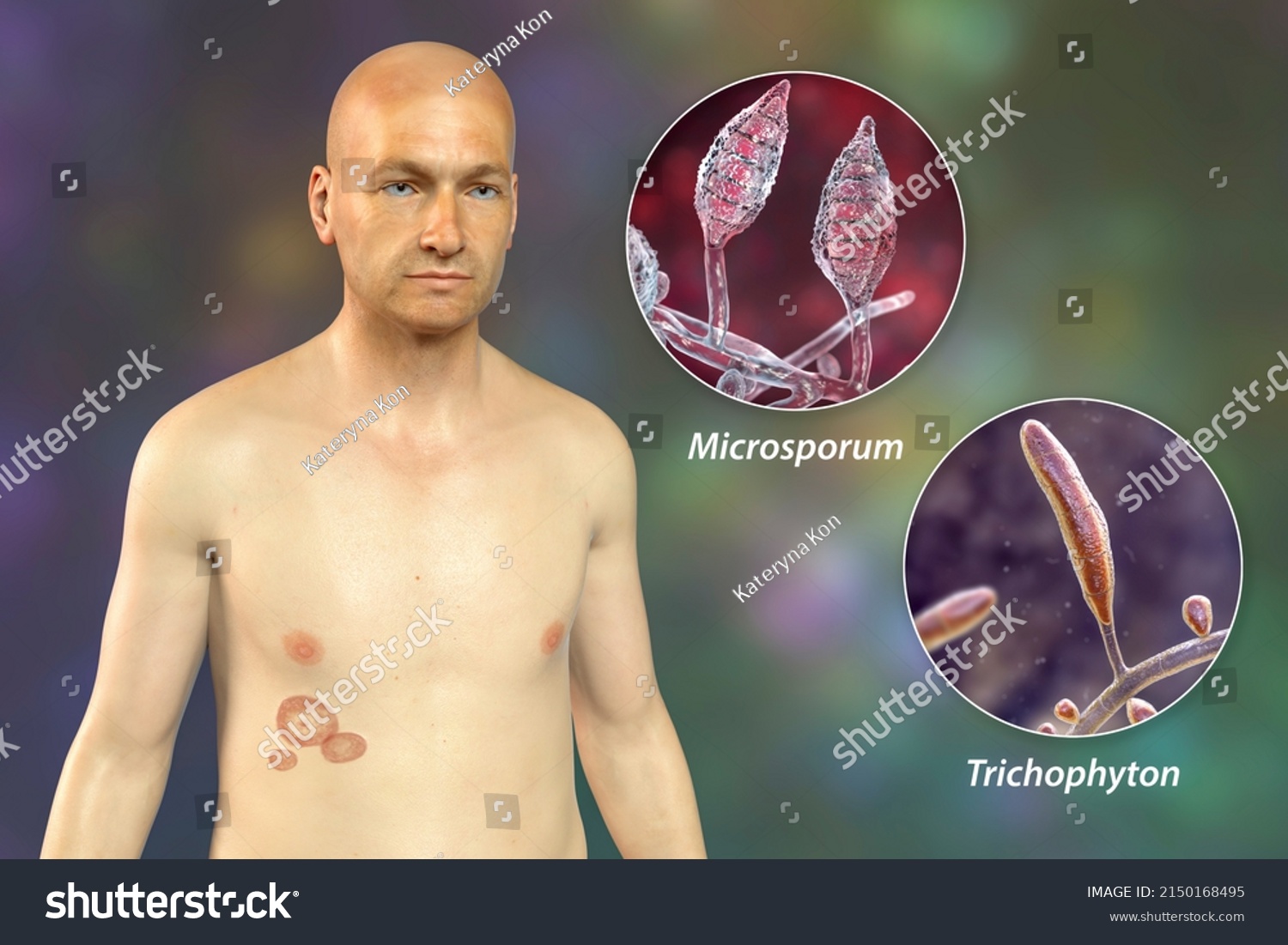 Fungal Infection On Mans Body Tinea Ilustrações Stock 2150168495 Shutterstock 