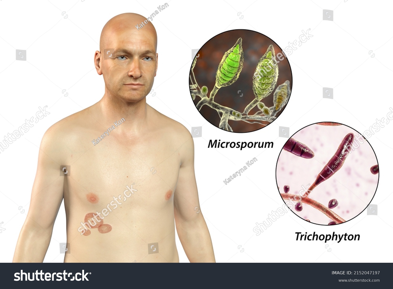 Fungal Infection On Mans Body Tinea Ilustrações Stock 2152047197 Shutterstock 