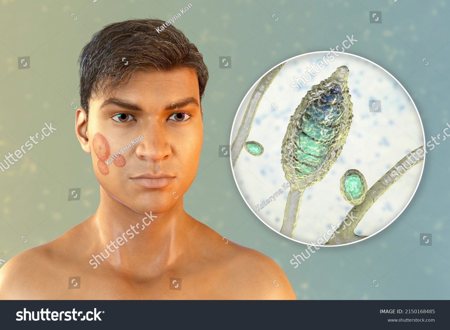 Fungal Infection On Mans Face 3d Stock Illustration 2150168485 ...