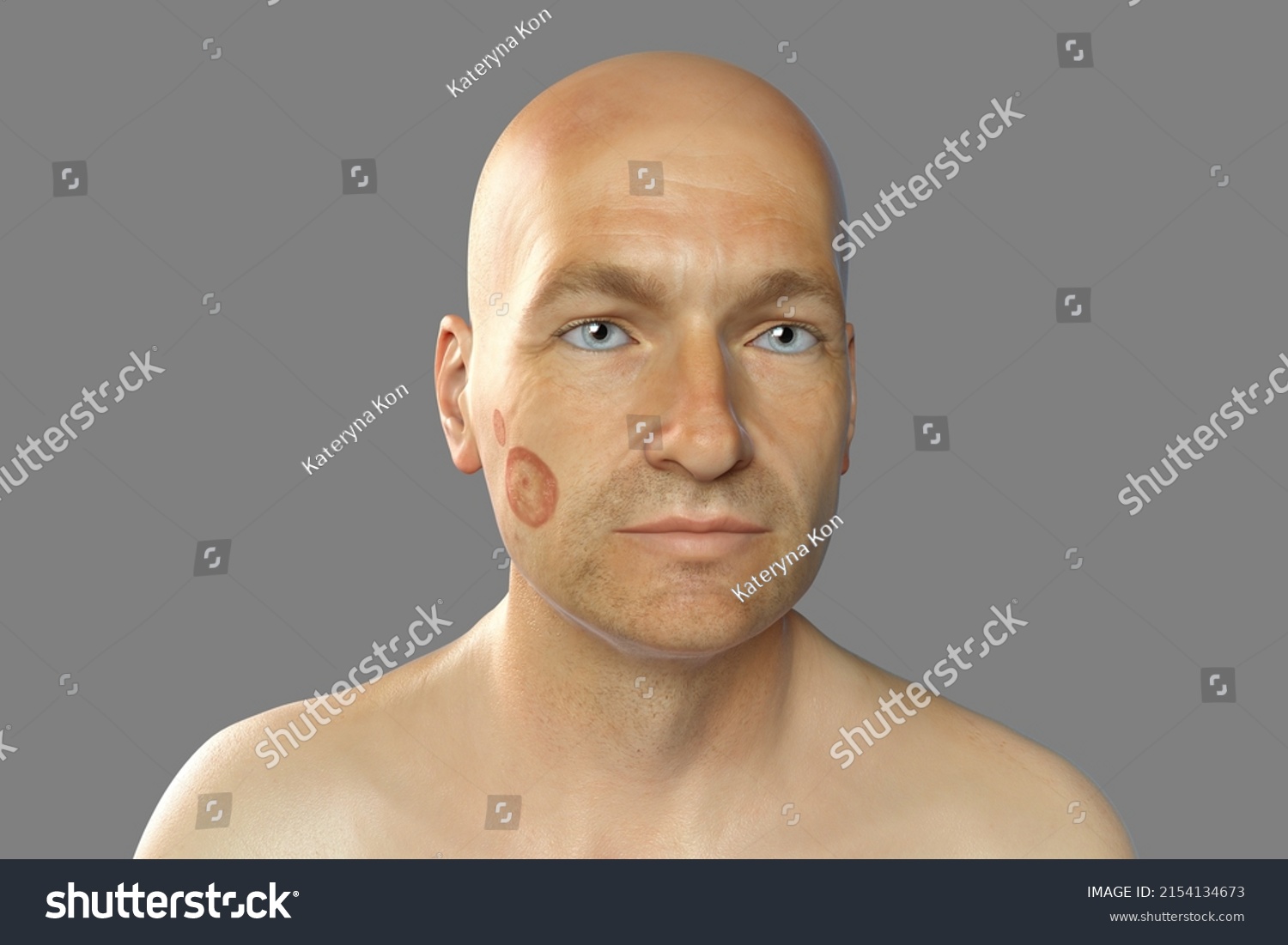 Fungal Infection On Mans Face 3d Stock Illustration 2154134673 Shutterstock 