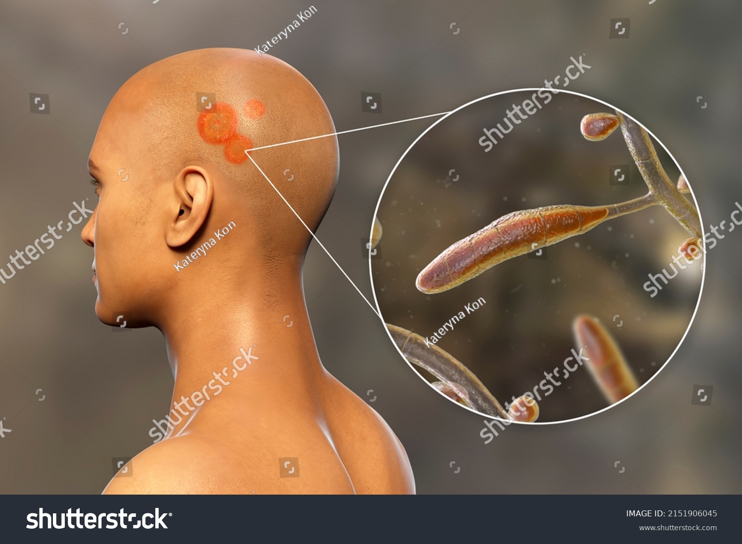 Fungal Infection On Mans Head 3d Stock Illustration 2151906045 Shutterstock 