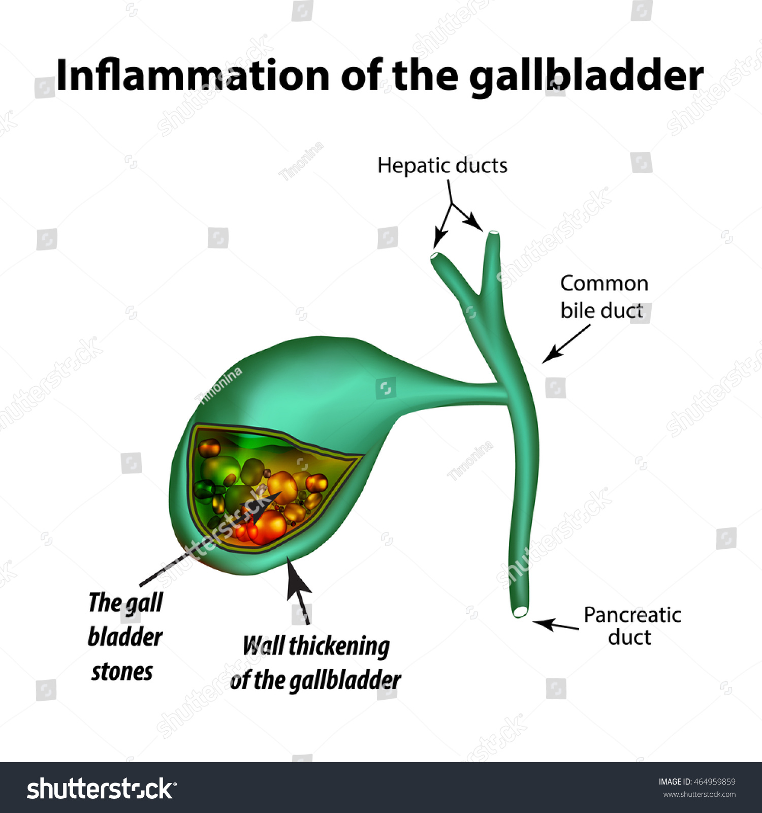 Gallstones Cholelithiasis Cholecystitis Inflammation Gallbladder ...