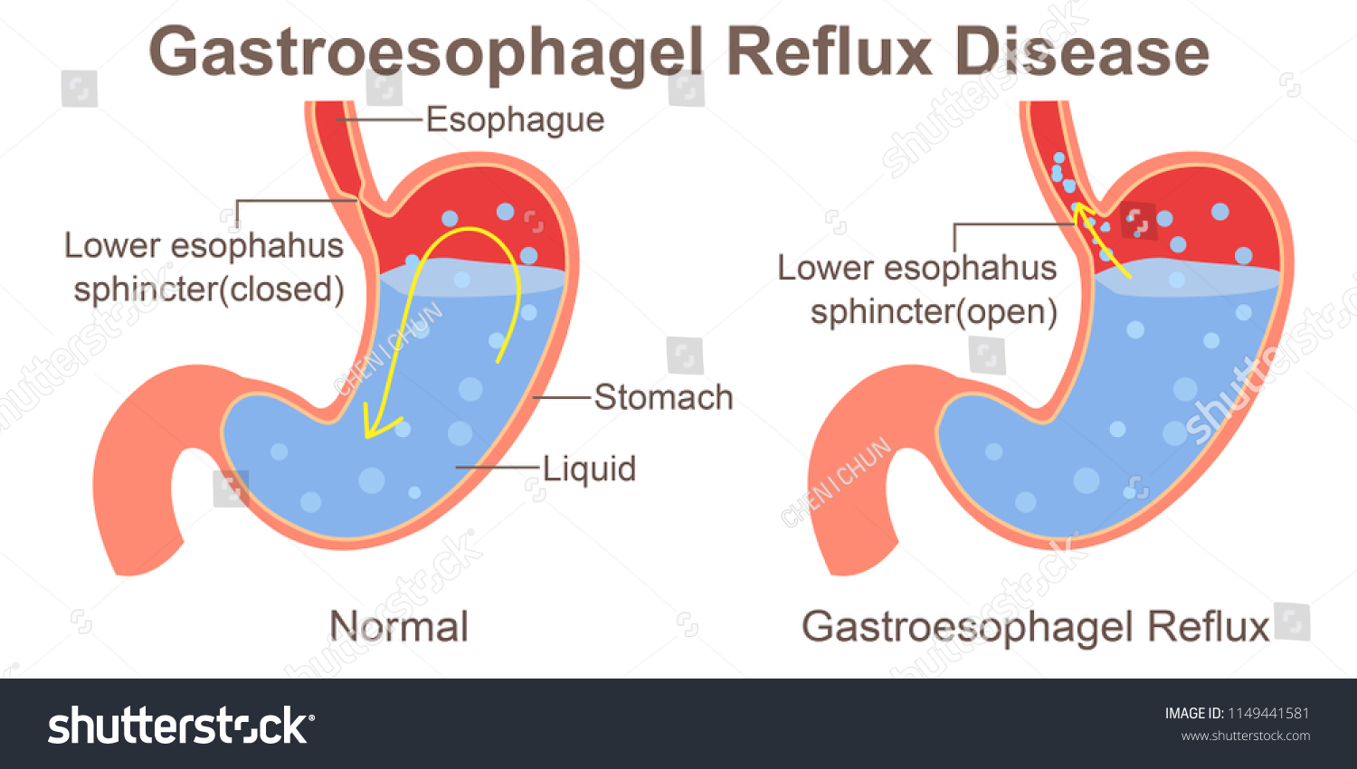 498 Esophageal sphincter Images, Stock Photos & Vectors Biology Diagrams