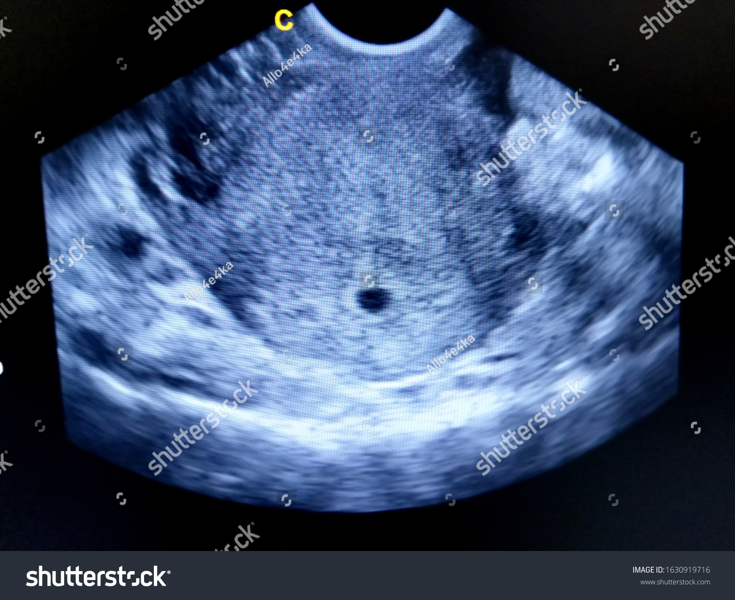 Weeks 4 ultrasound at 4 Week