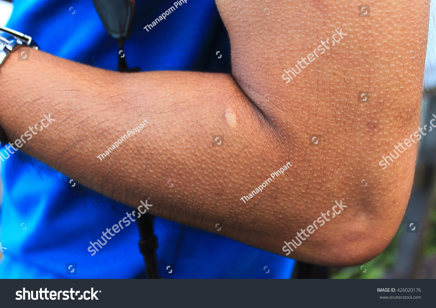 goose-pimples-goose-flesh-which-bumps-stock-photo-426020176-shutterstock