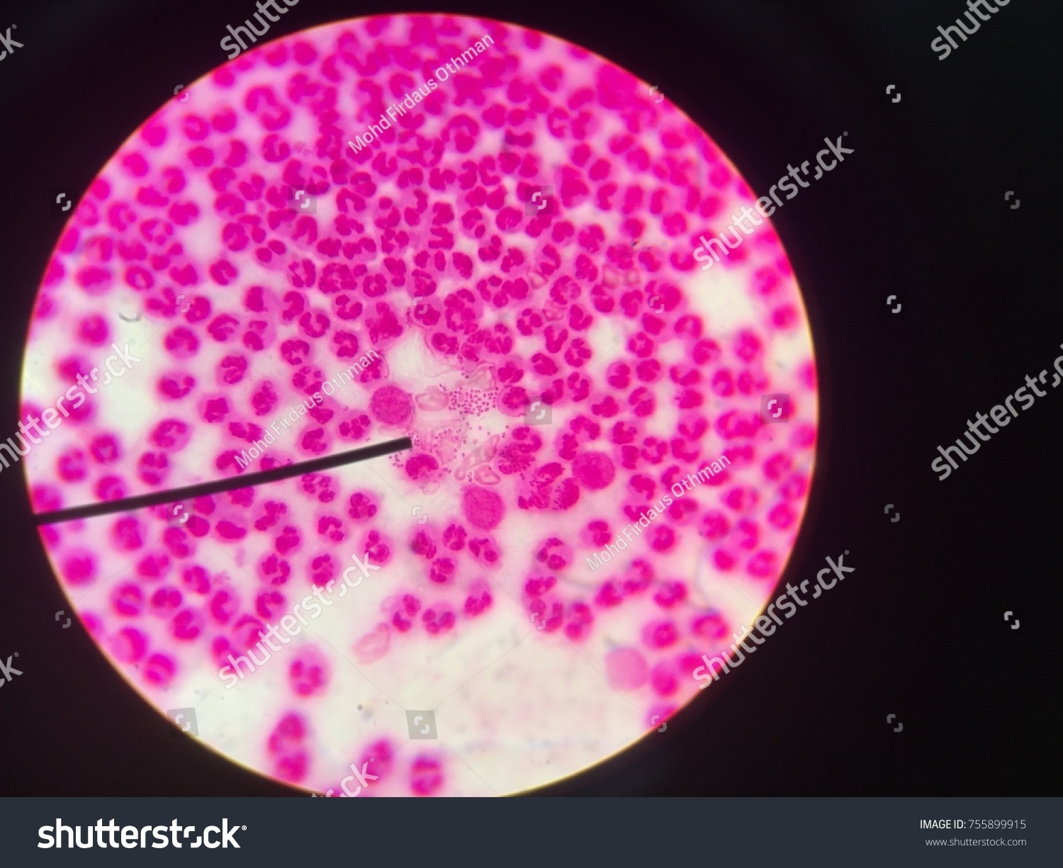 Diplococcus in the smear: what does it show Diplococcus in the smear: what does it show