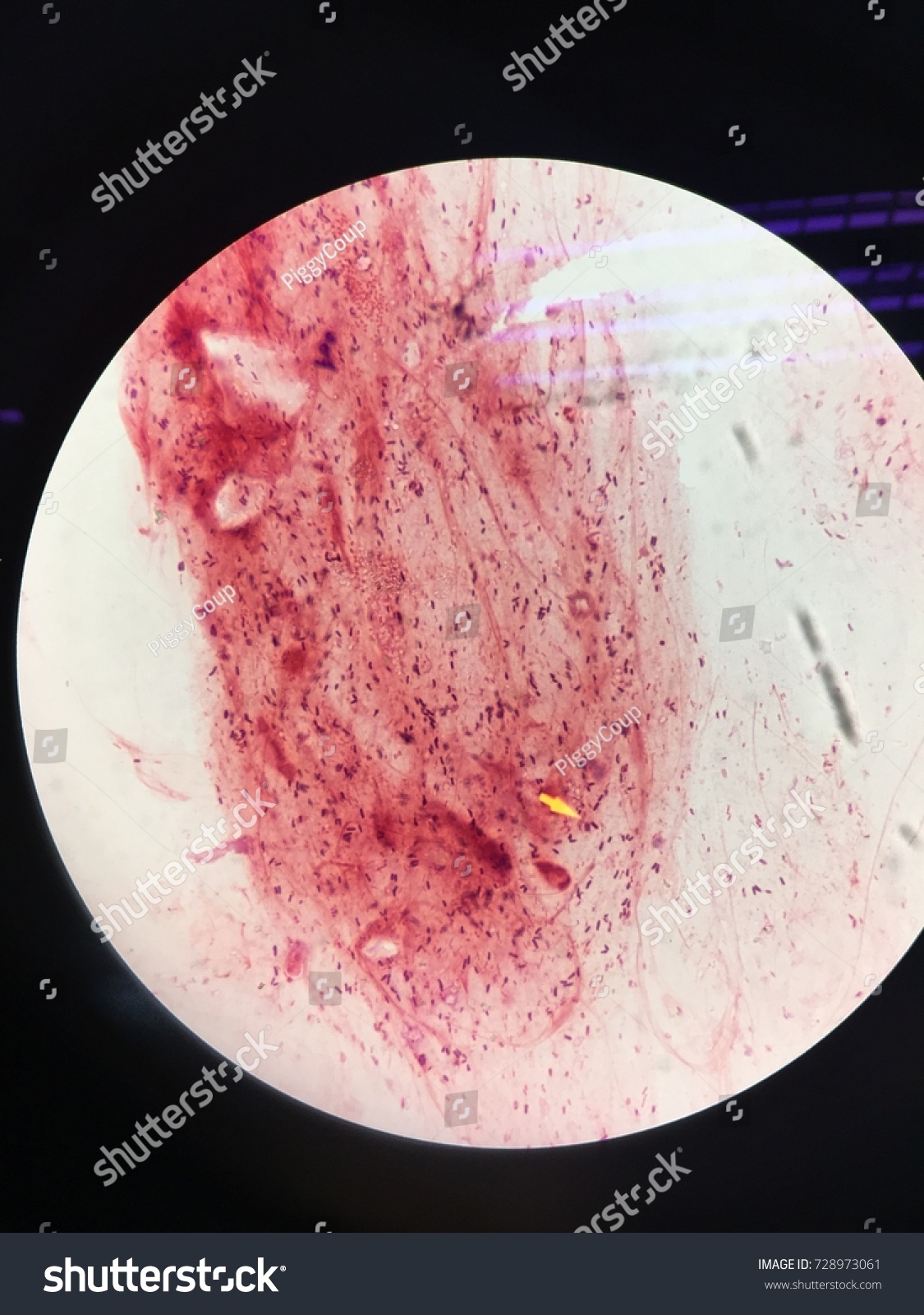 Diplococcus in the smear: what does it show Diplococcus in the smear: what does it show