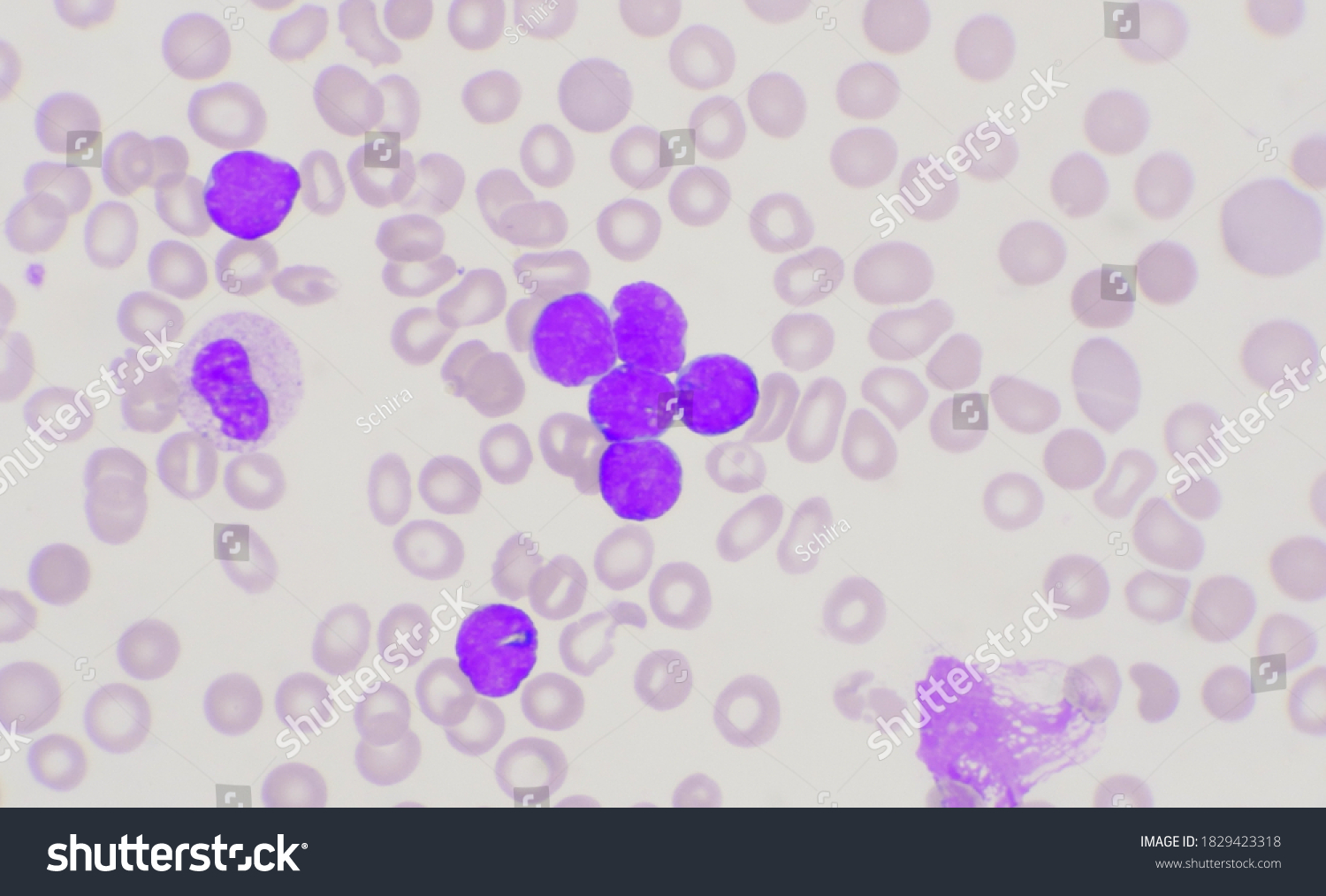 Group Blast Cells Leukemia Blood Smear Stock Photo (Edit Now) 1829423318