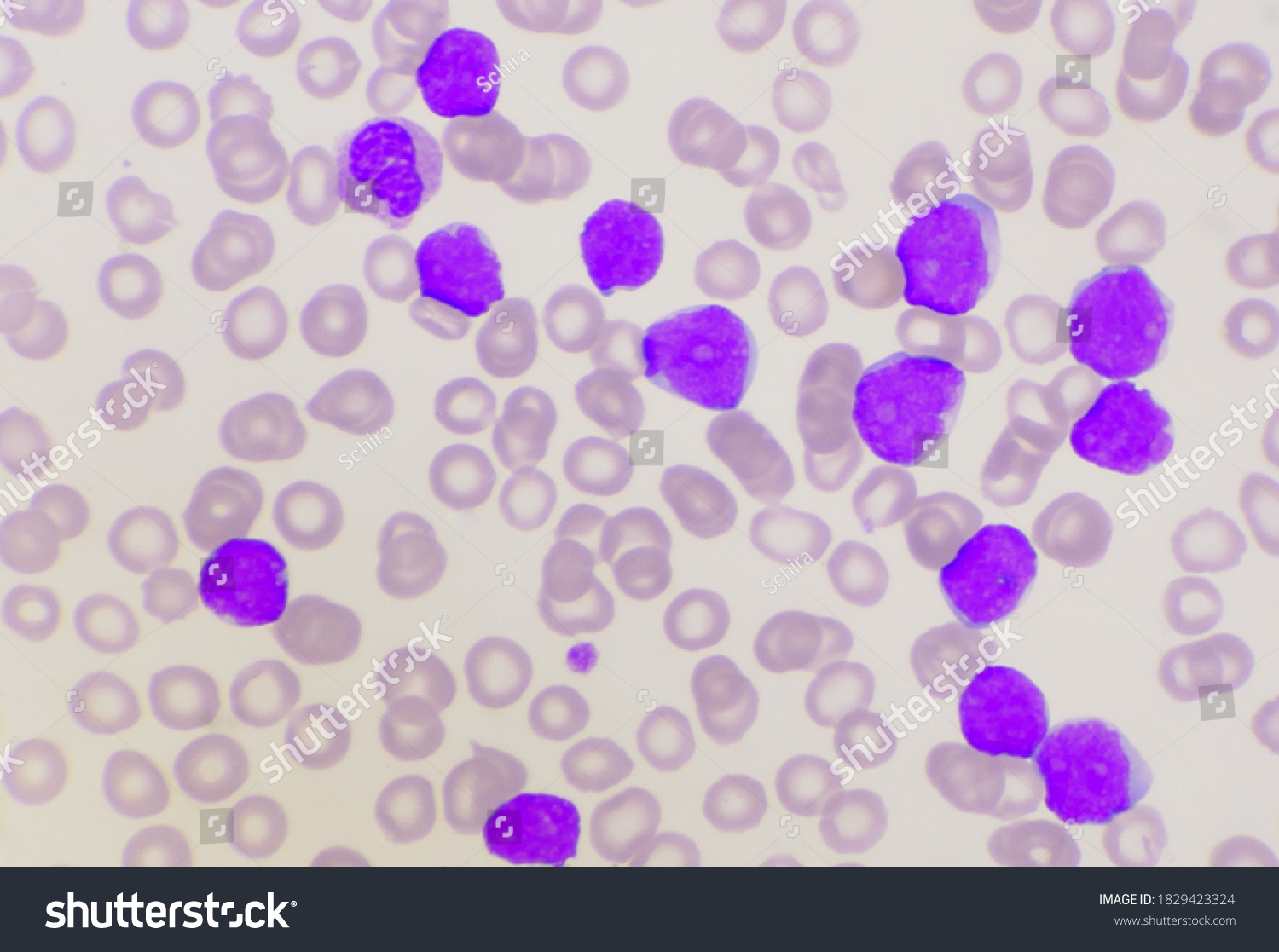 Group Blast Cells Leukemia Blood Smear Stock Photo (edit Now) 1829423324