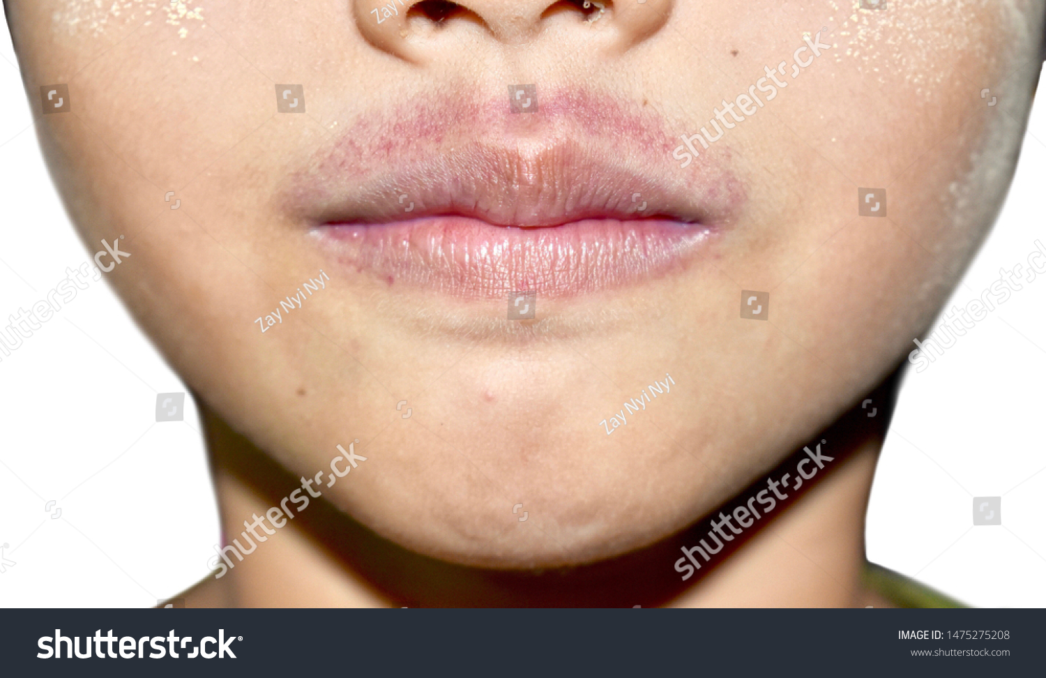 Groups Red Spots Petechiae Above Upper Stock Photo Edit Now 1475275208