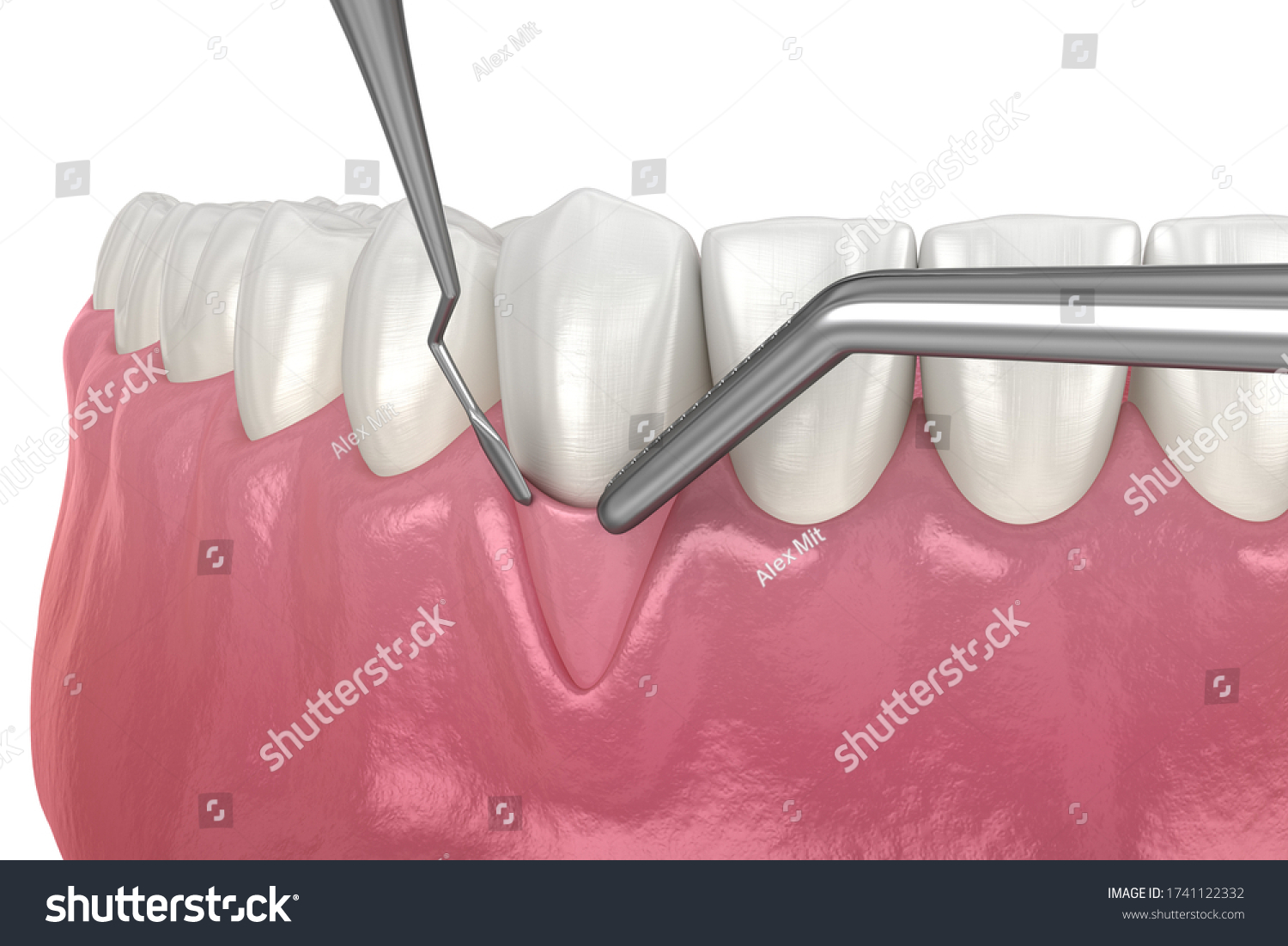 Gingival Graft Images Stock Photos And Vectors Shutterstock