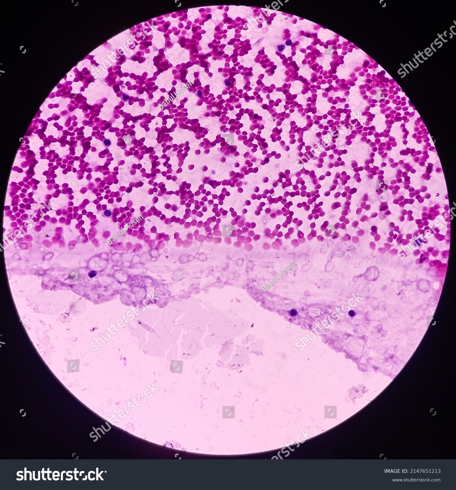 Gynacomastia Microphotograph Male Breast Lump Show Stock Photo ...