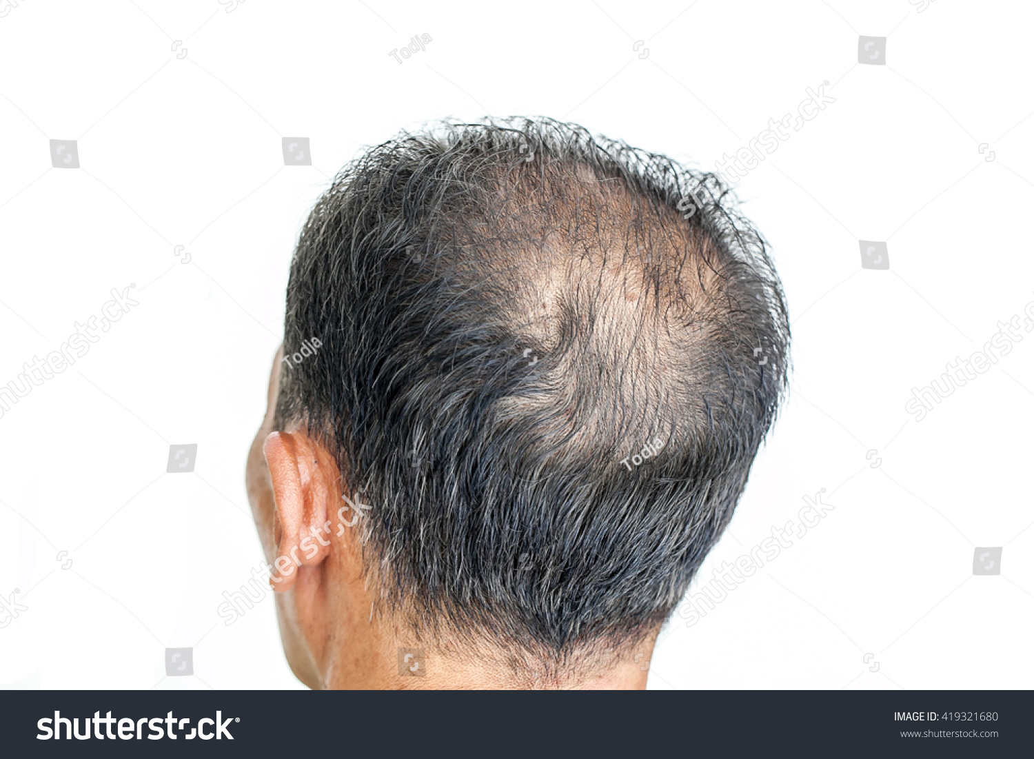 Hair Loss Male Head Hair Loss Stock Photo Edit Now 419321680