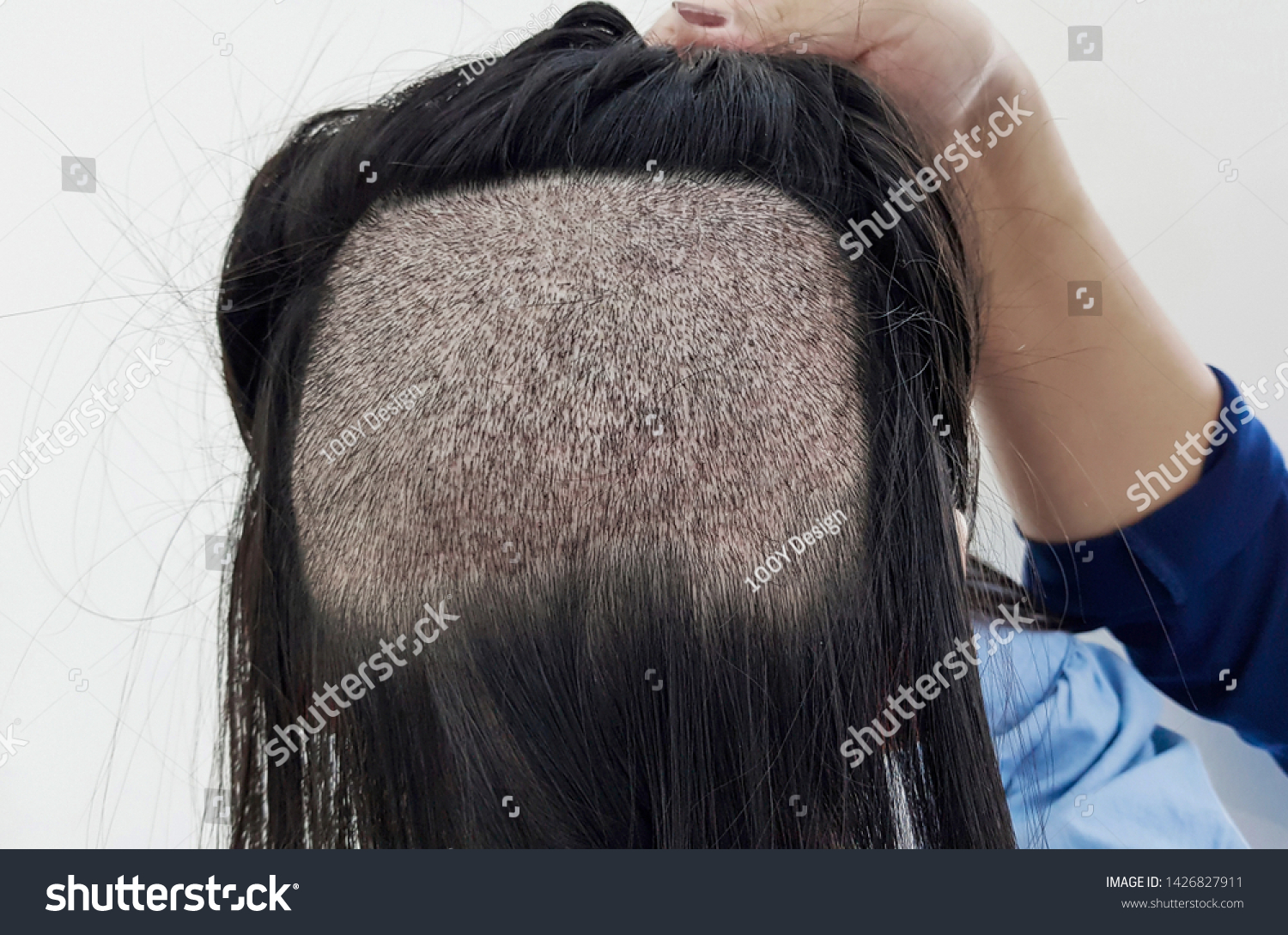 Hair Loss Problems Women Open Hairline Royalty Free Stock Image