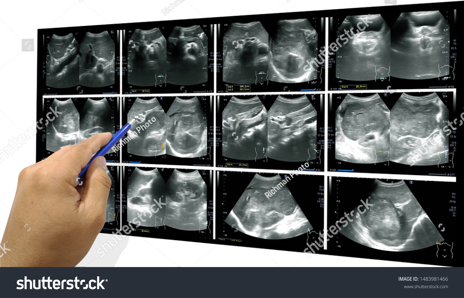Image result for doctor looking at spleen xray