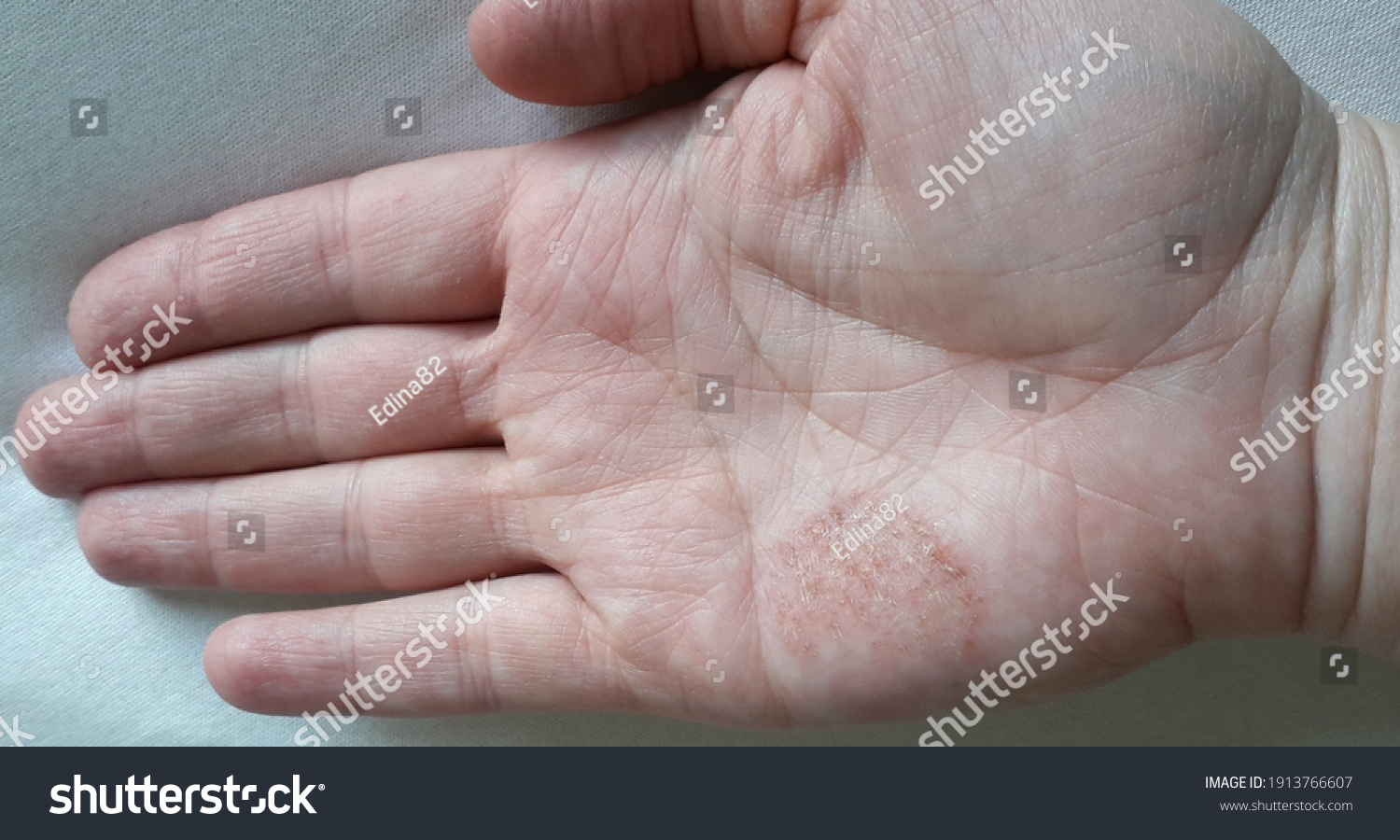 Hand Eczema Dyshidrotic Eczema On Palm foto stock (editar agora