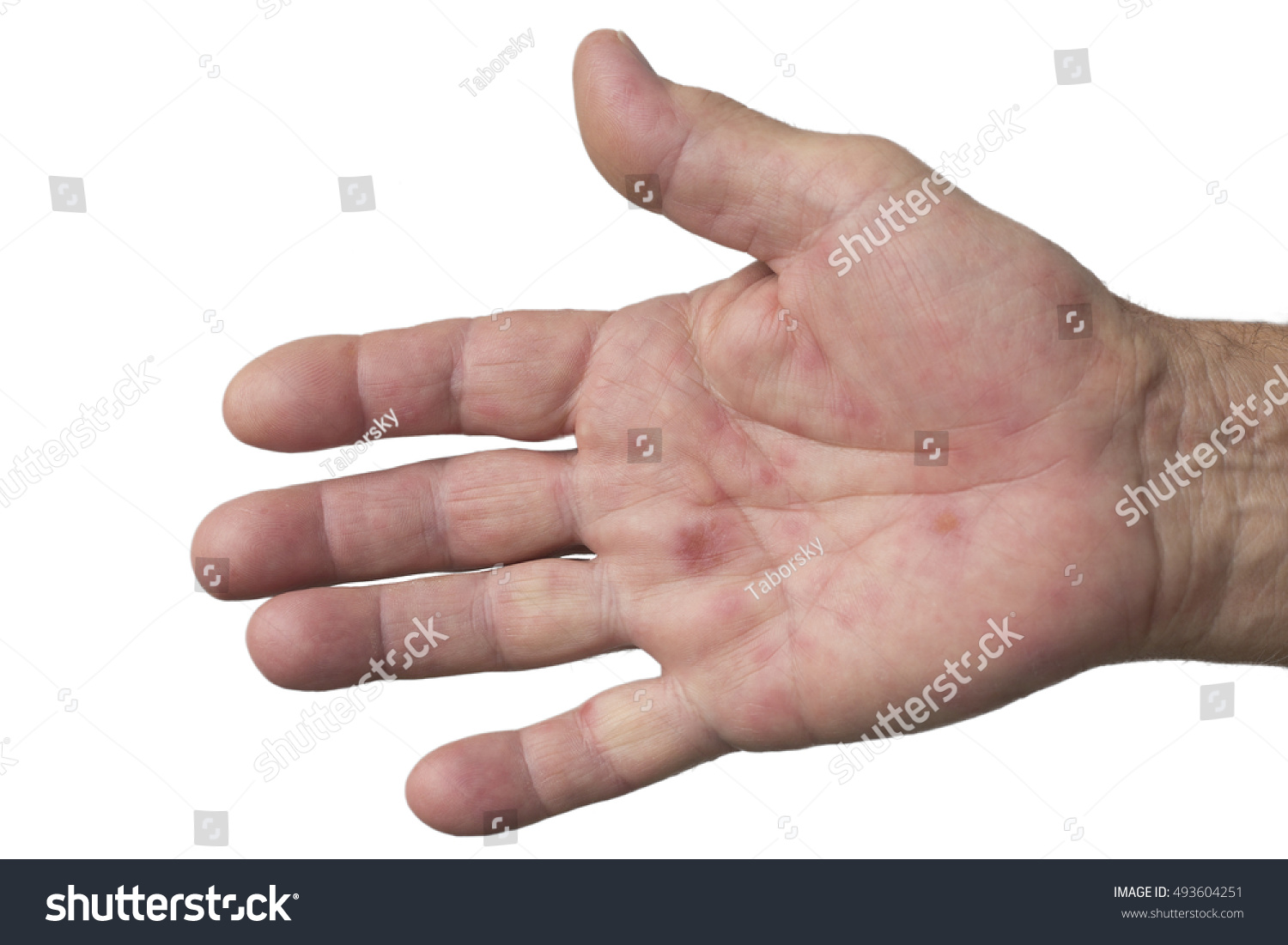 Hand Foot Mouth Disease Hfmd Palm Stock Photo 493604251