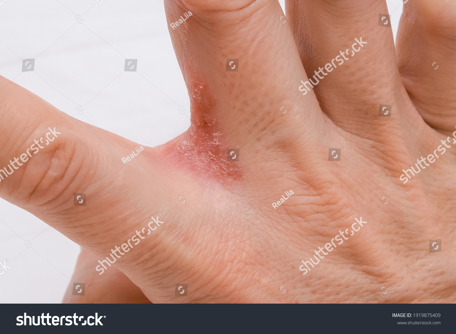 Hand Interdigital Dermatitis Dyshidrotic Eczema On Stockfoto Nu