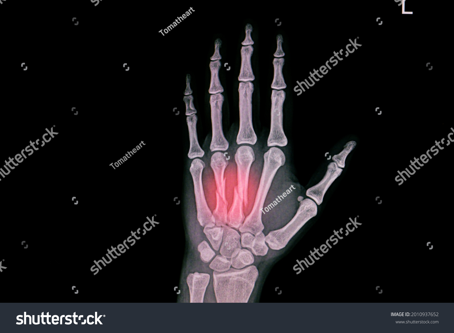 Hand Xray Showing Closed Fracture Third Stock Photo (Edit Now) 2010937652