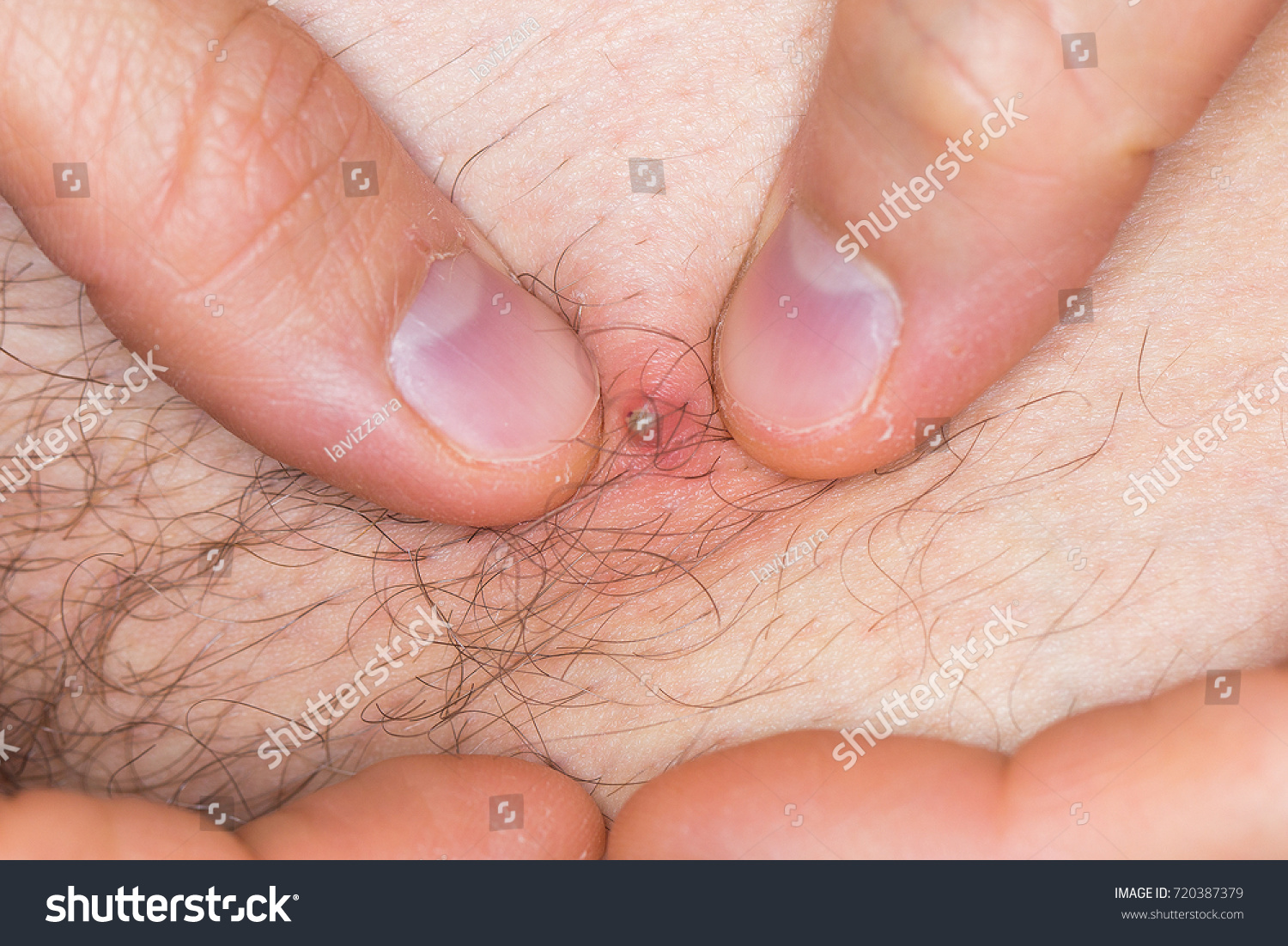 Hands Caucasian Man Squeezing Pimple Due Stock Photo Edit Now