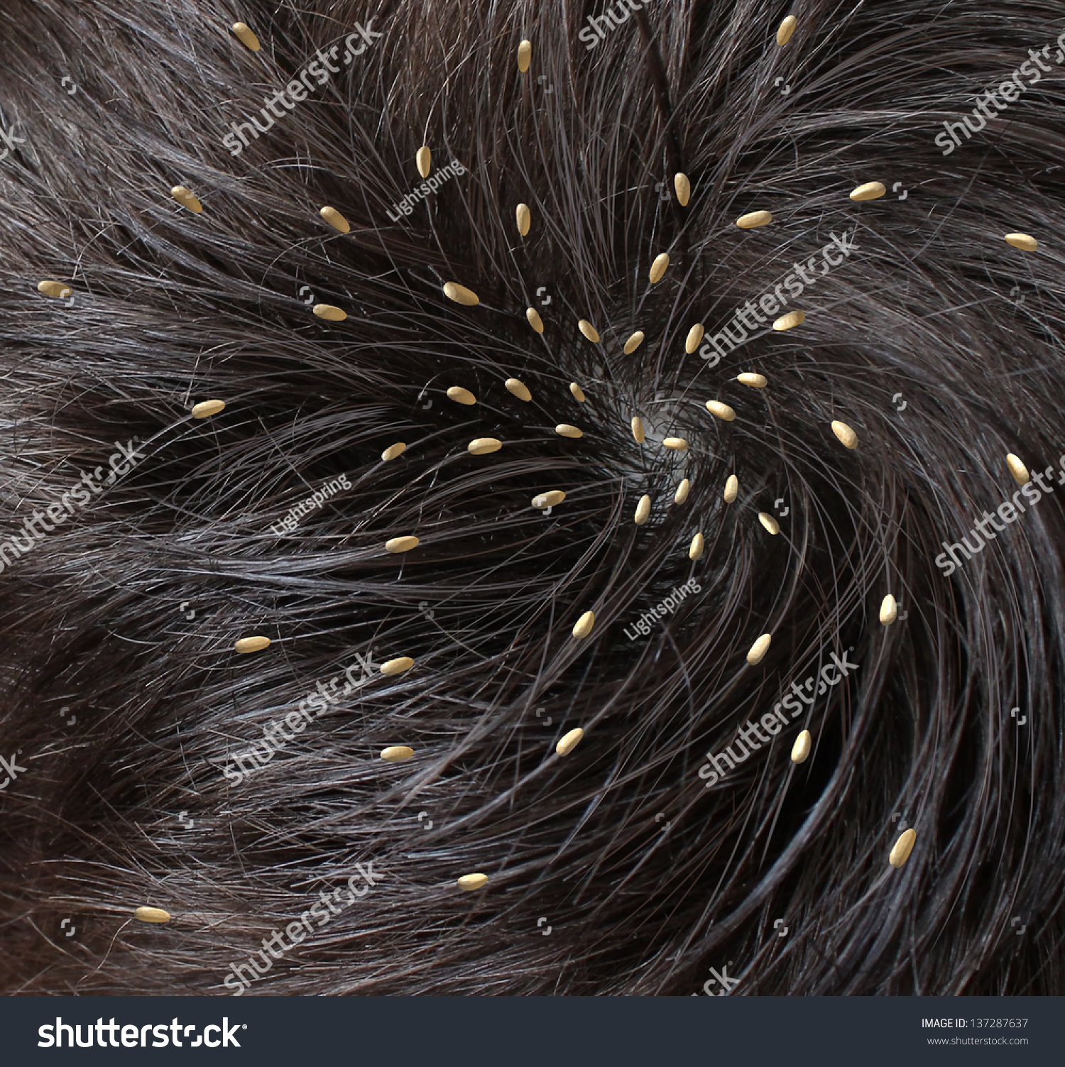 Head Lice Medical Concept Close Human Stock Illustration 137287637 ...