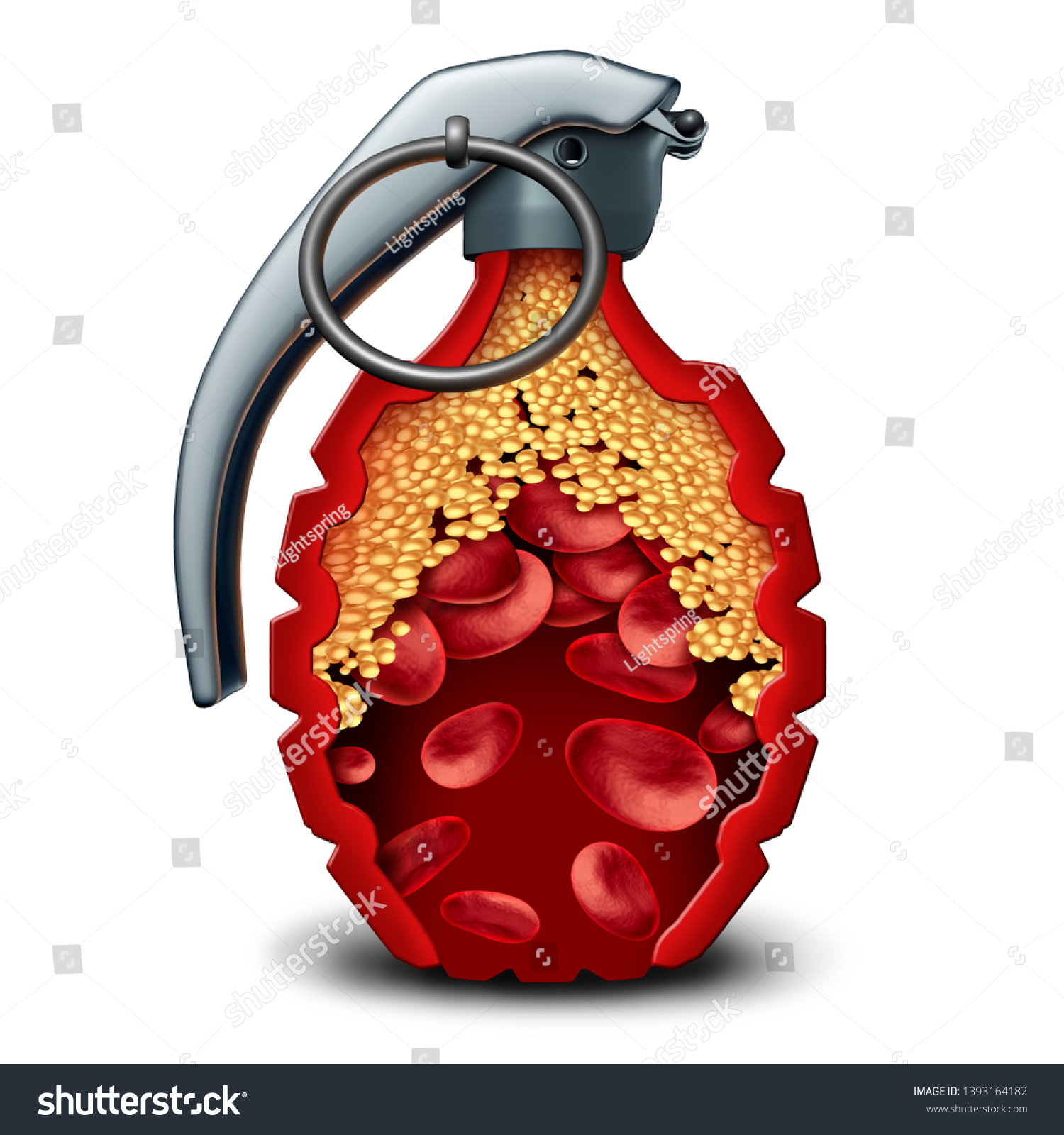 動脈に詰まったプラーク形成と3dイラストのアテローム性動脈硬化を伴う 動脈内に生の手榴弾を持つ 心臓病爆弾とコレステロールの危険性冠動脈疾患 の イラスト素材
