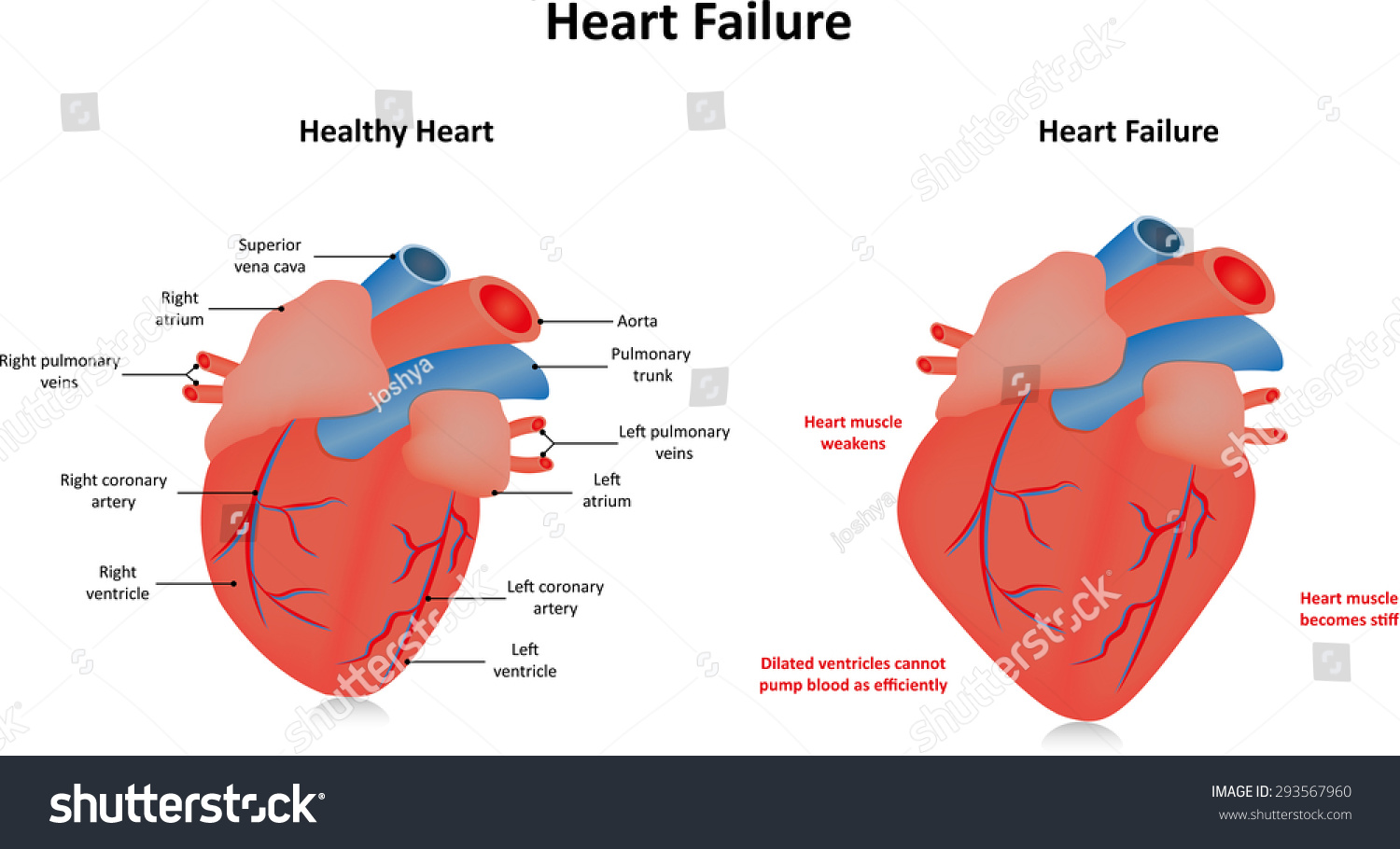 4 Left ventricular ejection fraction Images, Stock Photos & Vectors ...