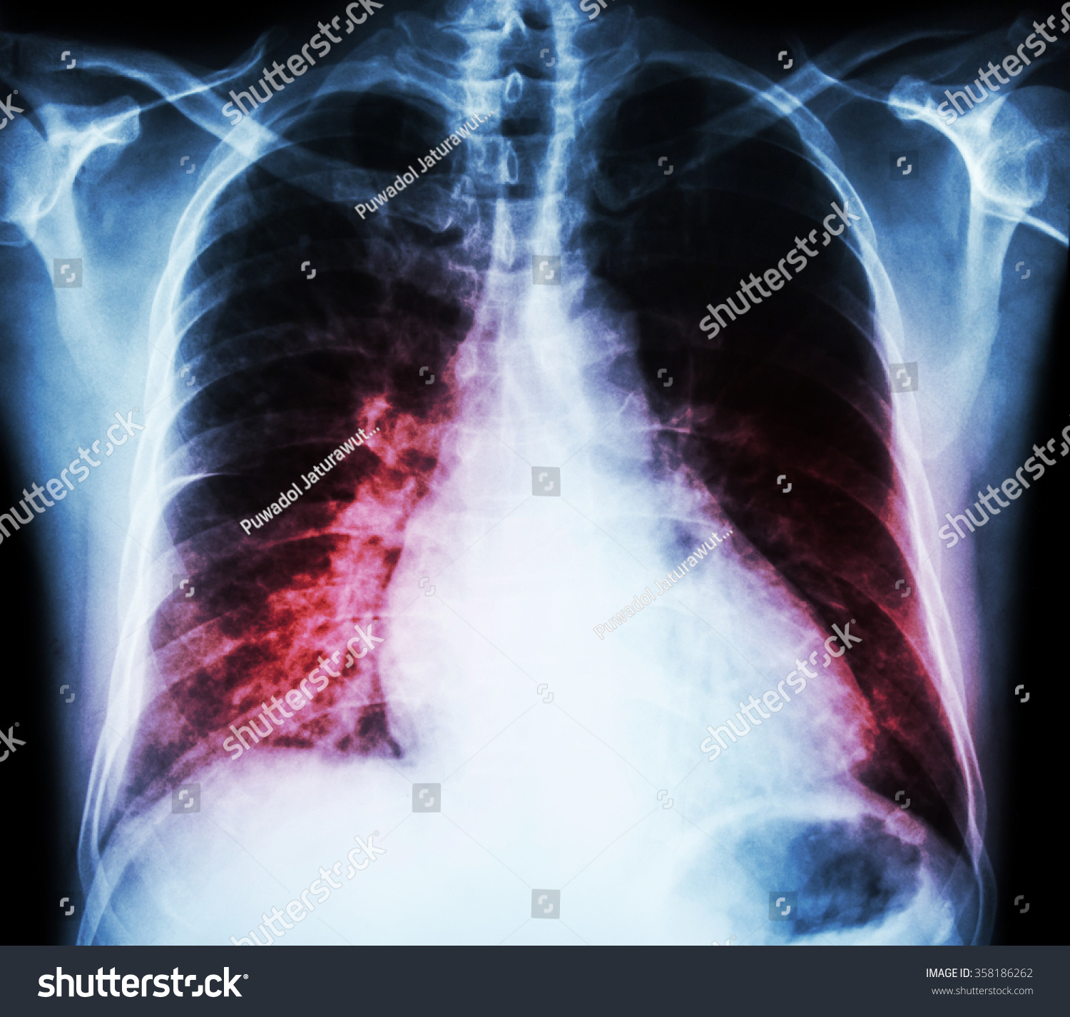 Heart Failure Film Xray Chest Pa Stock Photo (Edit Now) 358186262