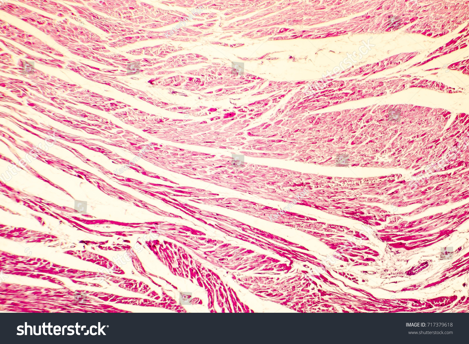 heart-hypertrophy-photomicrograph-showing-hypertrophic-myocardium-stock