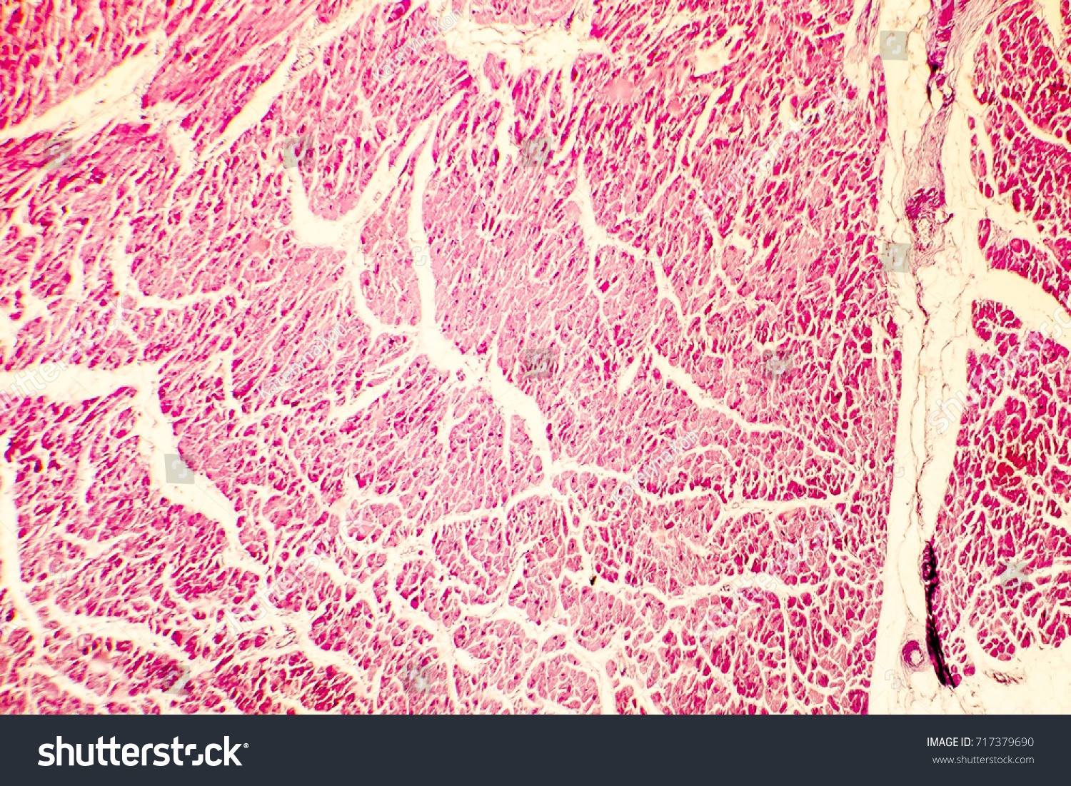 Heart Hypertrophy Photomicrograph Showing Hypertrophic Myocardium Stock ...