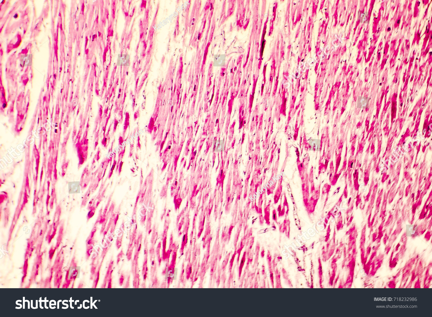 Heart Hypertrophy Photomicrograph Showing Hypertrophic Myocardium Stock ...