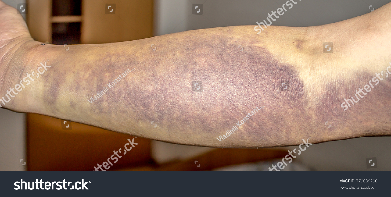 Arm Hematoma Images Stock Photos Vectors Shutterstock