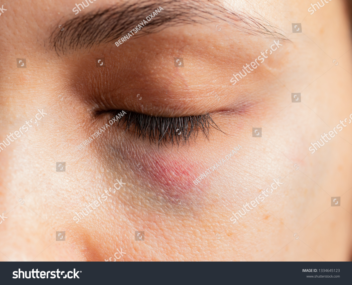 hematoma-under-eye-stock-photo-edit-now-1334645123