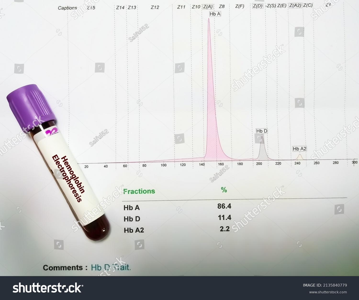 Hemoglobin Electrophoresis Report Blood Sample Showing 2135840779   Stock Photo Hemoglobin Electrophoresis Report With Blood Sample Showing Hemoglobin D Trait 2135840779 